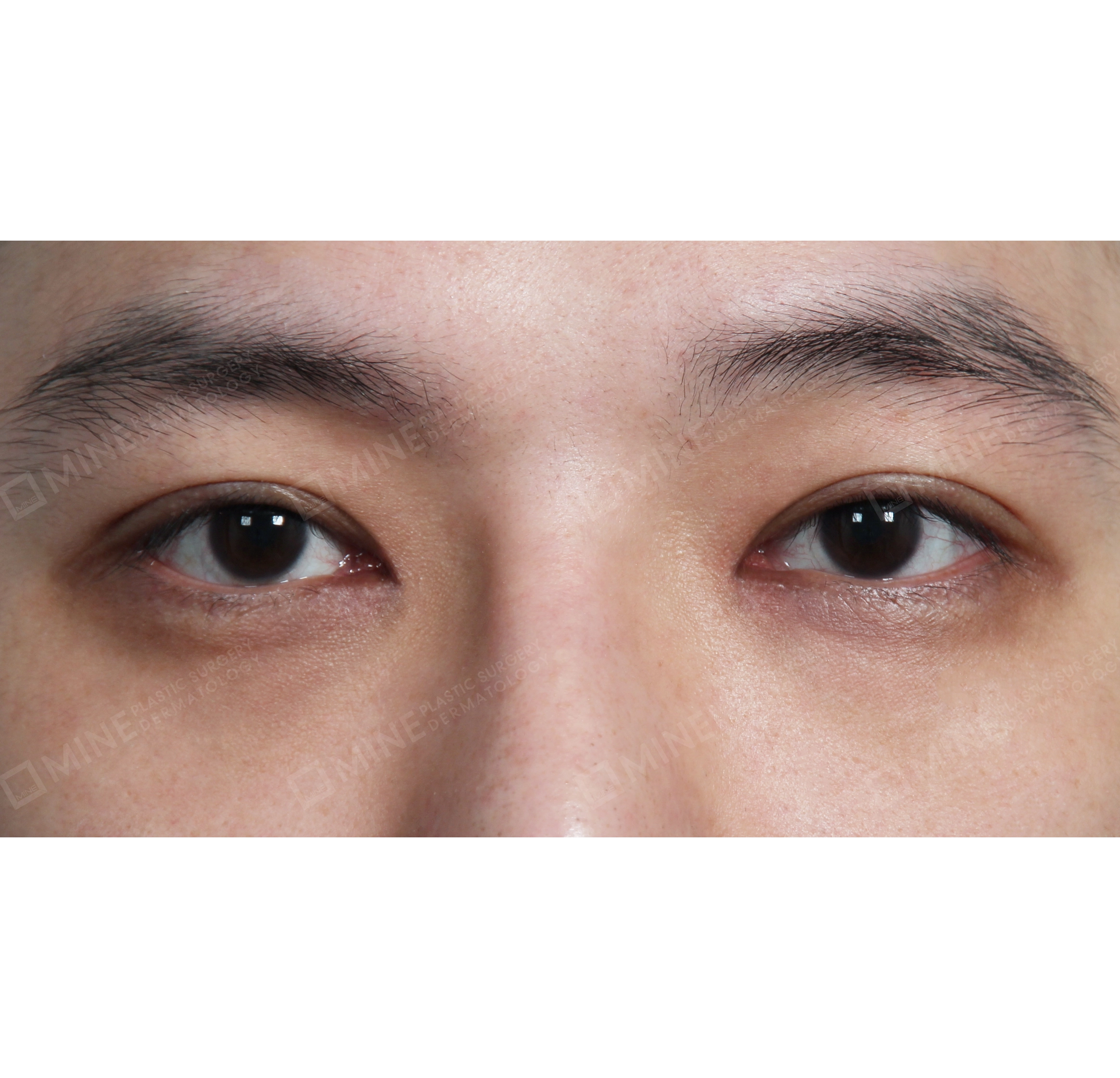 Lipatan Mata Ganda Non Insisi + Epi-Canthoplasty-Depan-Sesudah