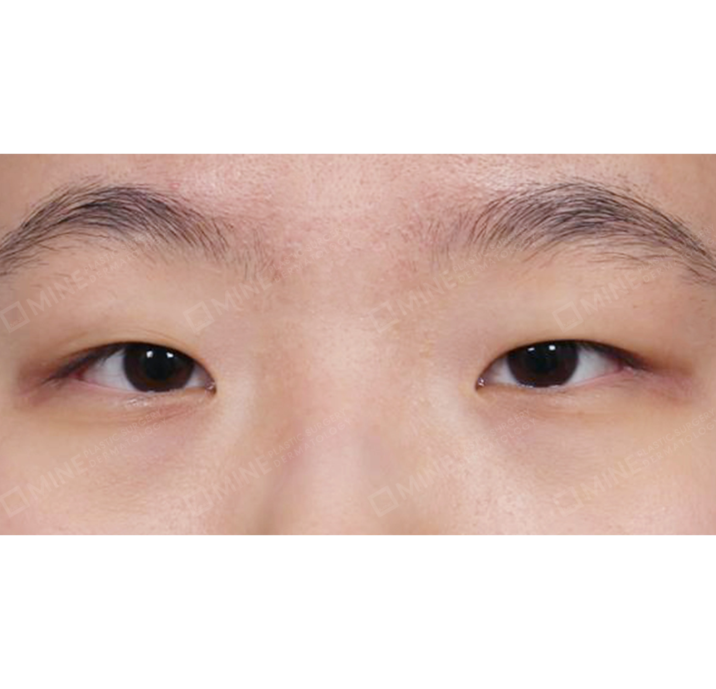 Koreksi Ptosis Insisi + Epi-Canthoplasty-Depan-Sebelum