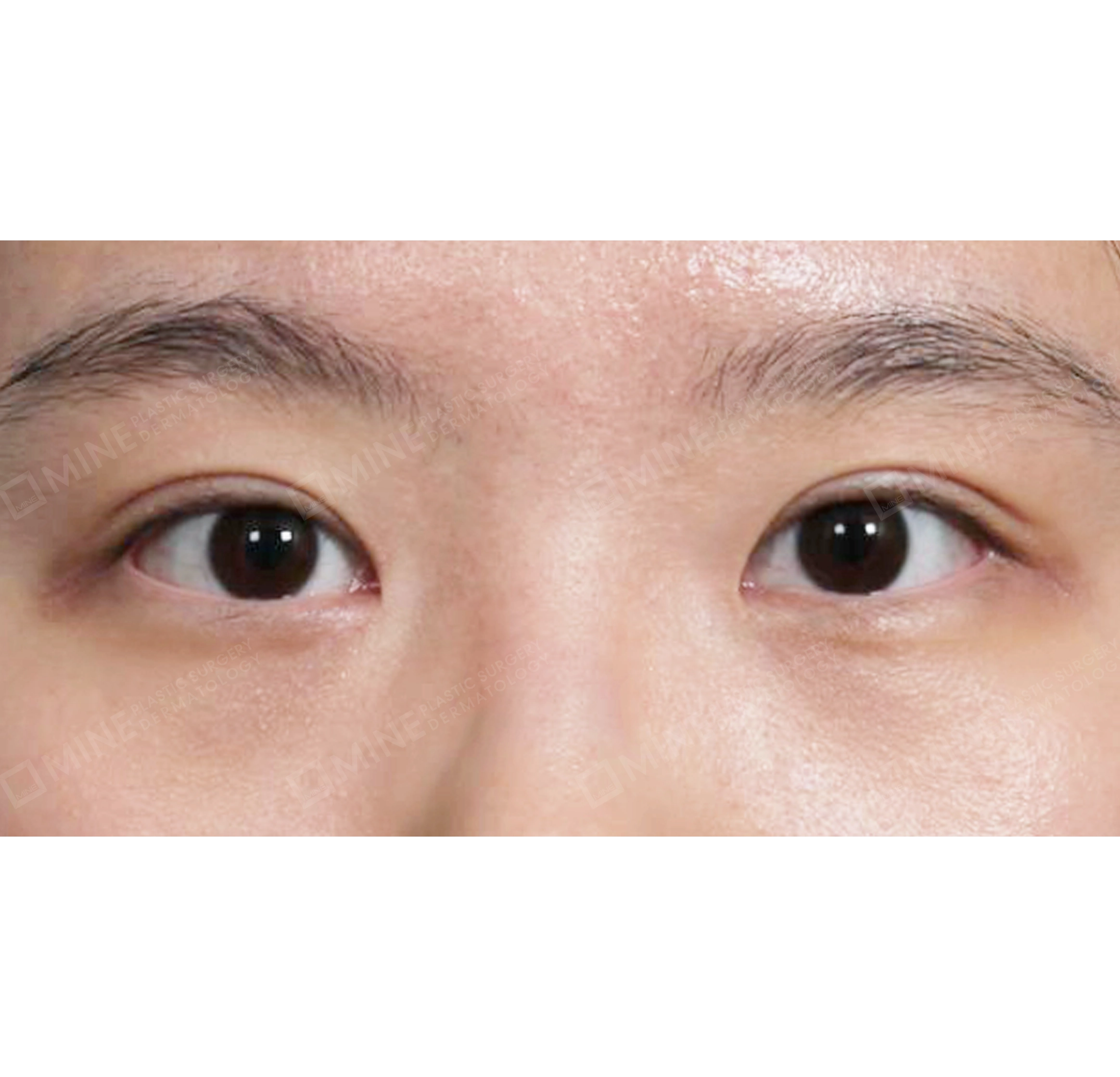 Koreksi Ptosis Insisi + Epi-Canthoplasty-Depan-Sesudah
