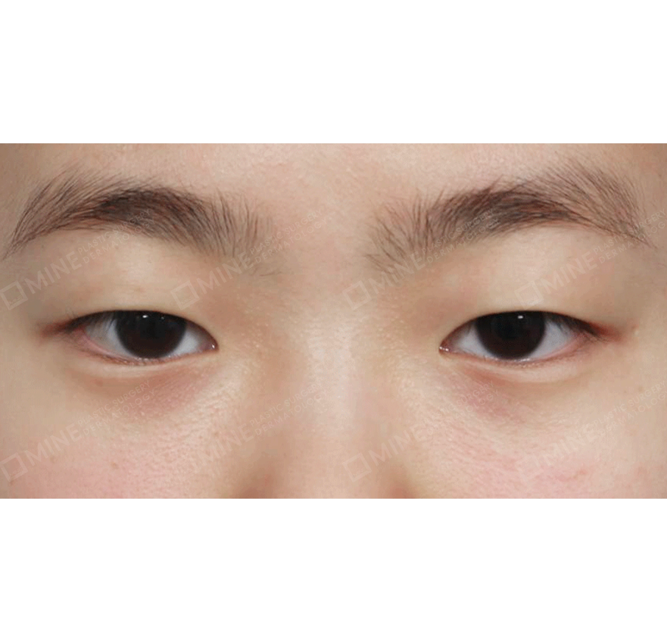Koreksi Ptosis Lipatan Mata Ganda Insisi Parsial-Depan-Sebelum
