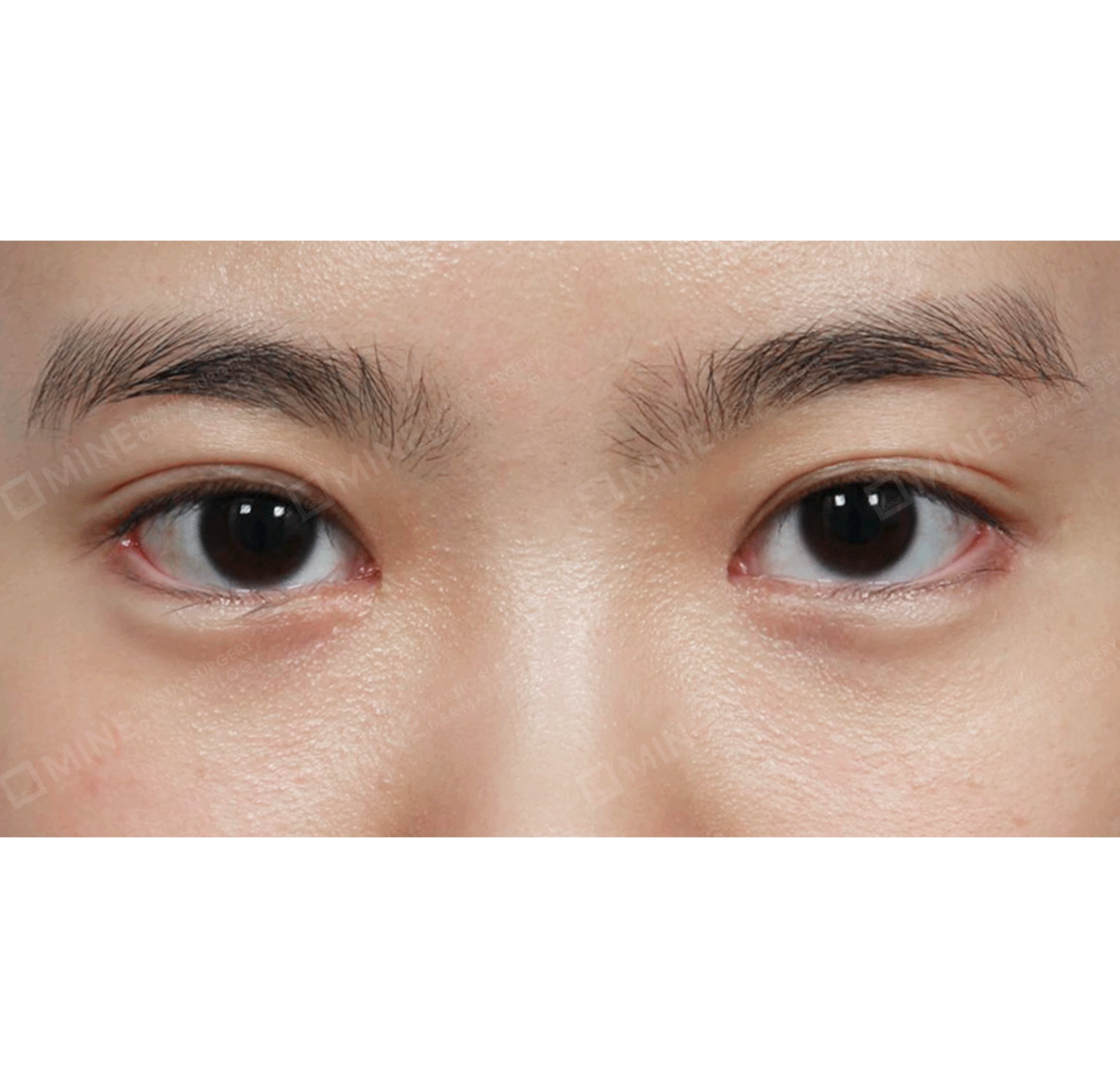 Koreksi Ptosis Lipatan Mata Ganda Insisi Parsial-Depan-Sesudah