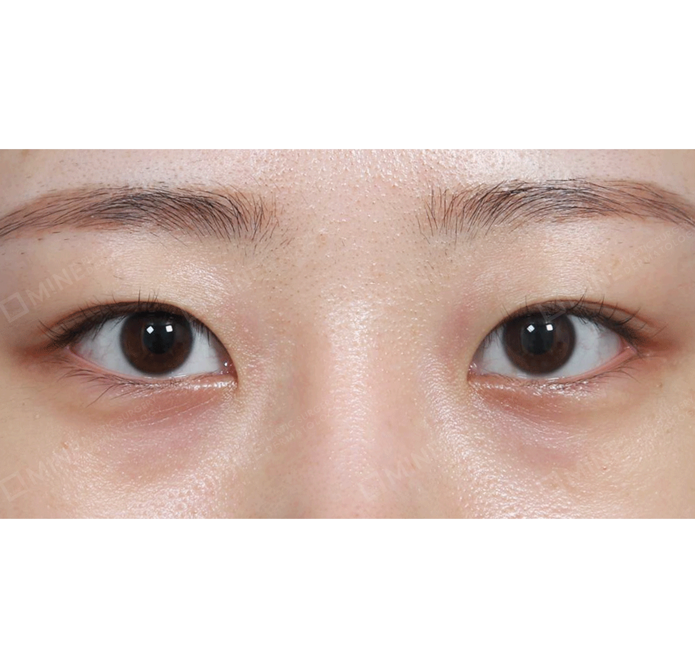 Koreksi Ptosis Non Insisi + Epi-Canthoplasty-Depan-Sebelum
