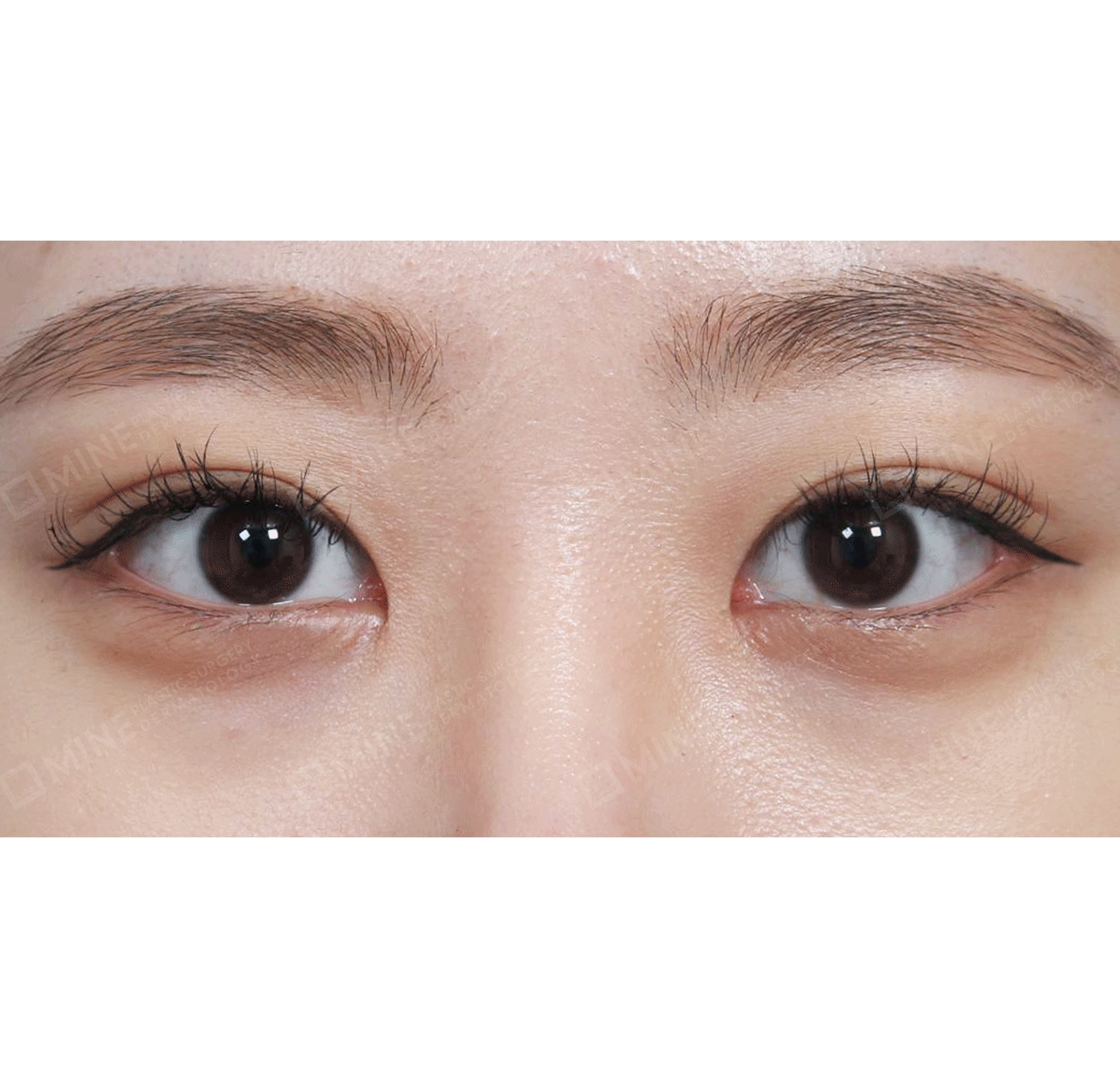 Koreksi Ptosis Non Insisi + Epi-Canthoplasty-Depan-Sesudah