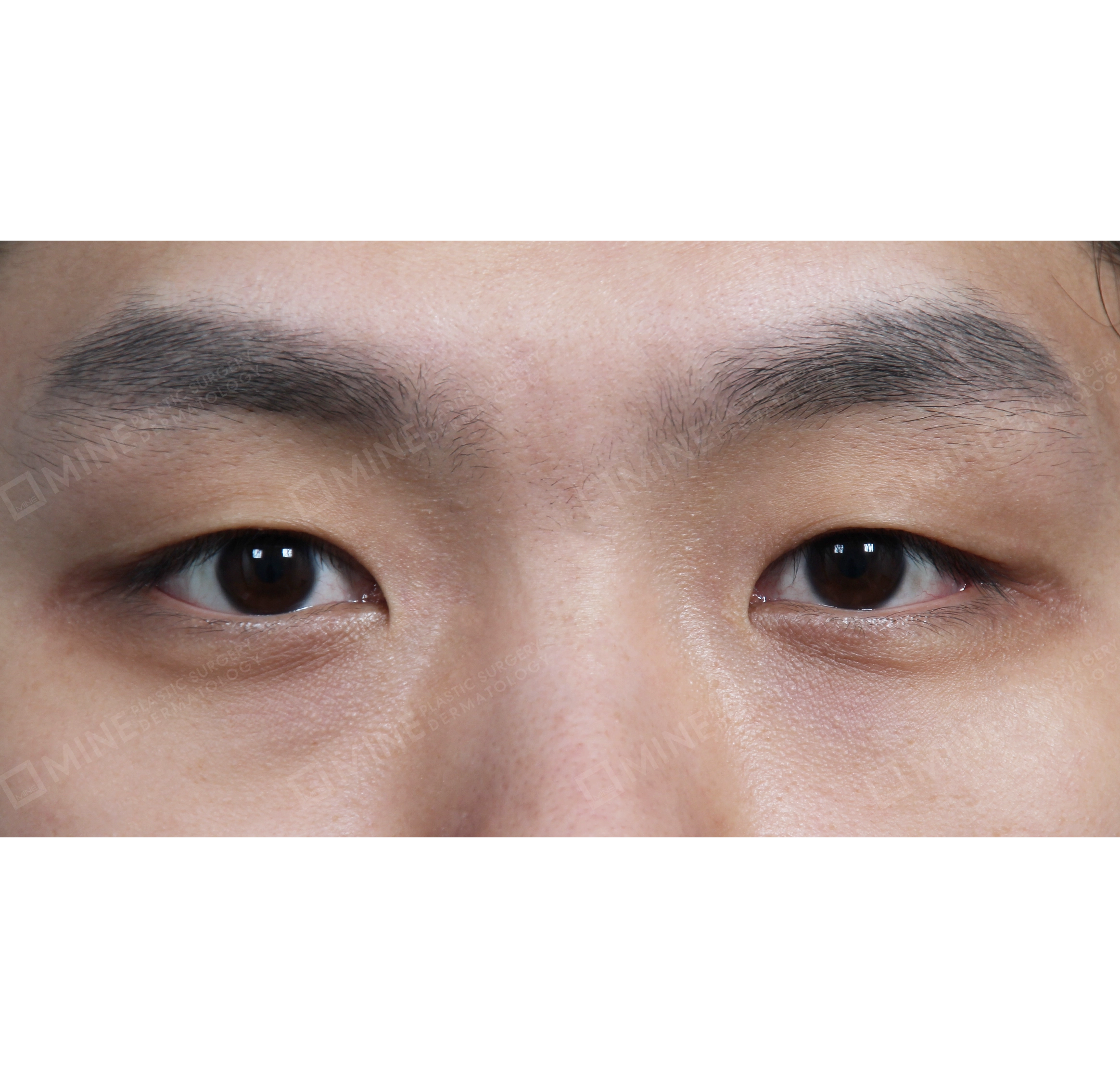 Lipatan Mata Ganda Non Insisi + Epi-Canthoplasty-Depan-Sebelum