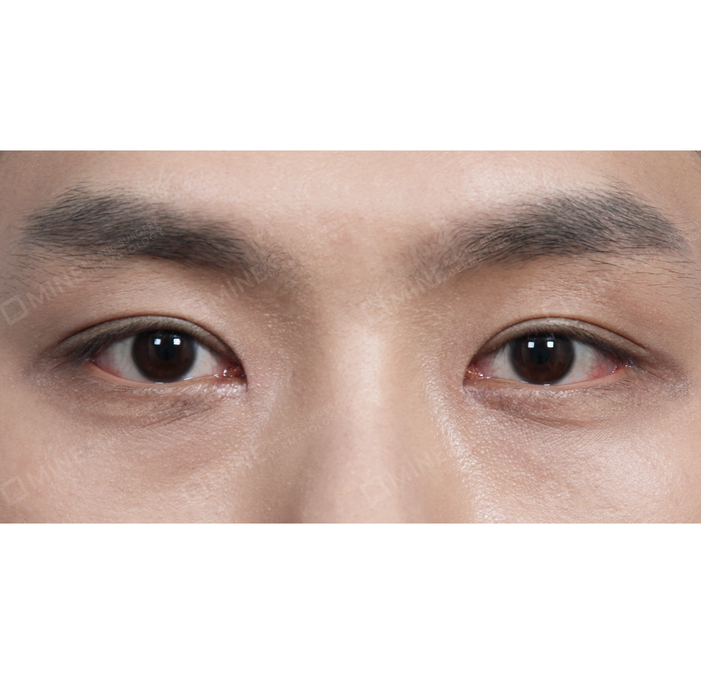 Lipatan Mata Ganda Non Insisi + Epi-Canthoplasty-Depan-Sesudah