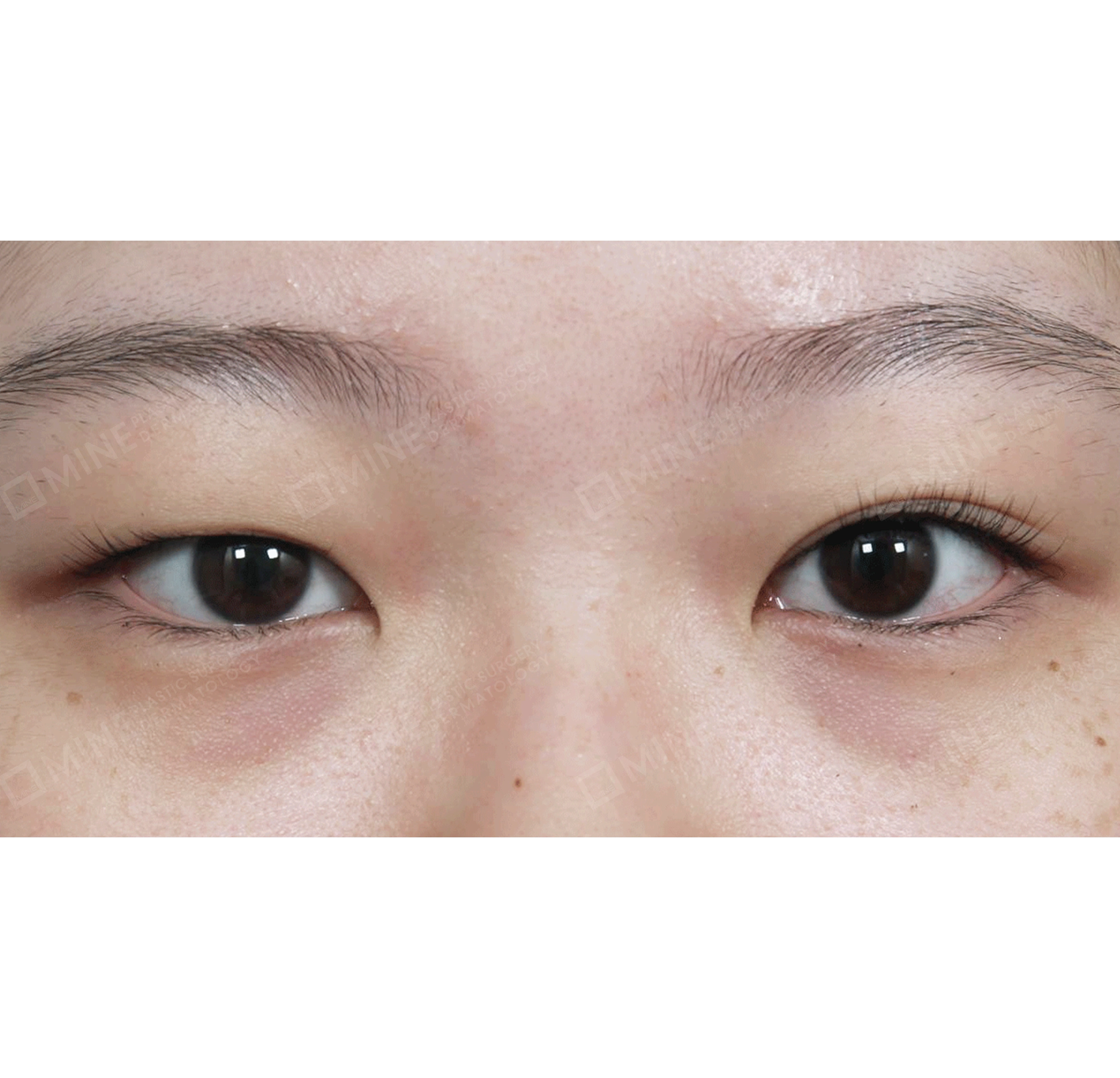 Revisi Operasi Mata + Koreksi Ptosis Lipatan Mata Ganda Non Insisi-Depan-Sebelum