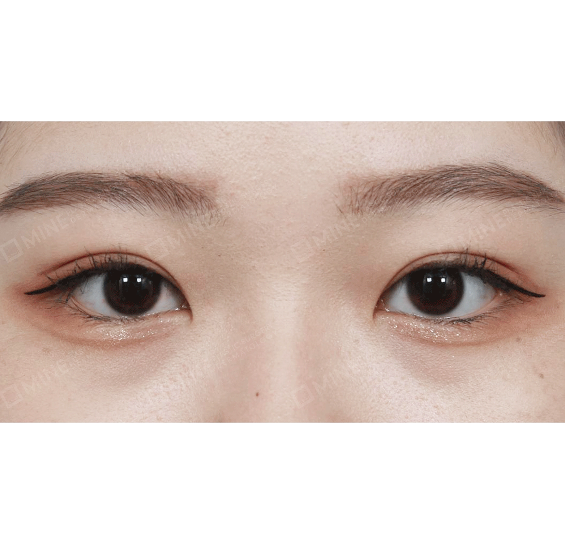 Revisi Operasi Mata + Koreksi Ptosis Lipatan Mata Ganda Non Insisi-Depan-Sesudah