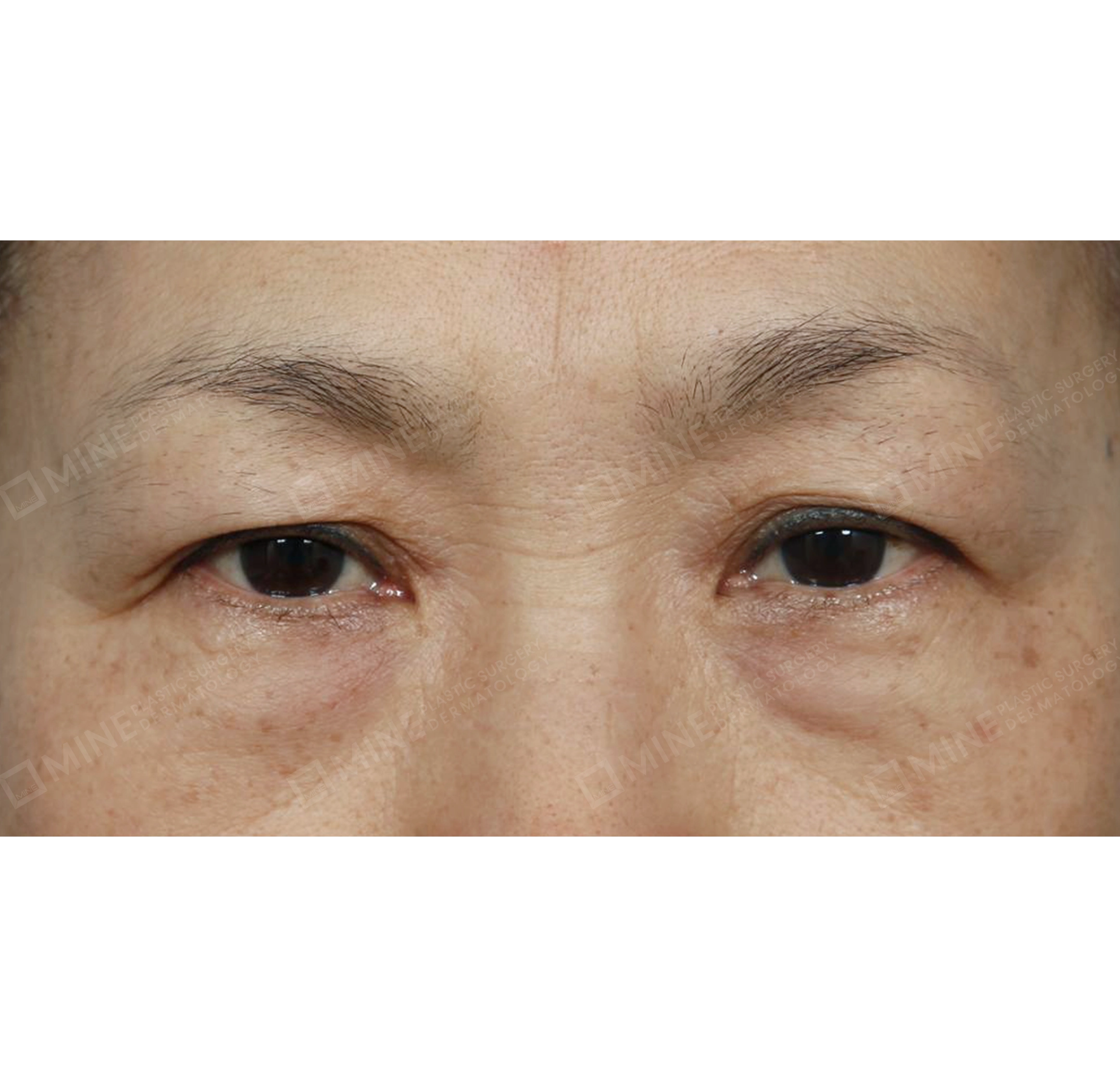 Lifting Bawah Alis + Koreksi Ptosis Insisi-Depan-Sebelum