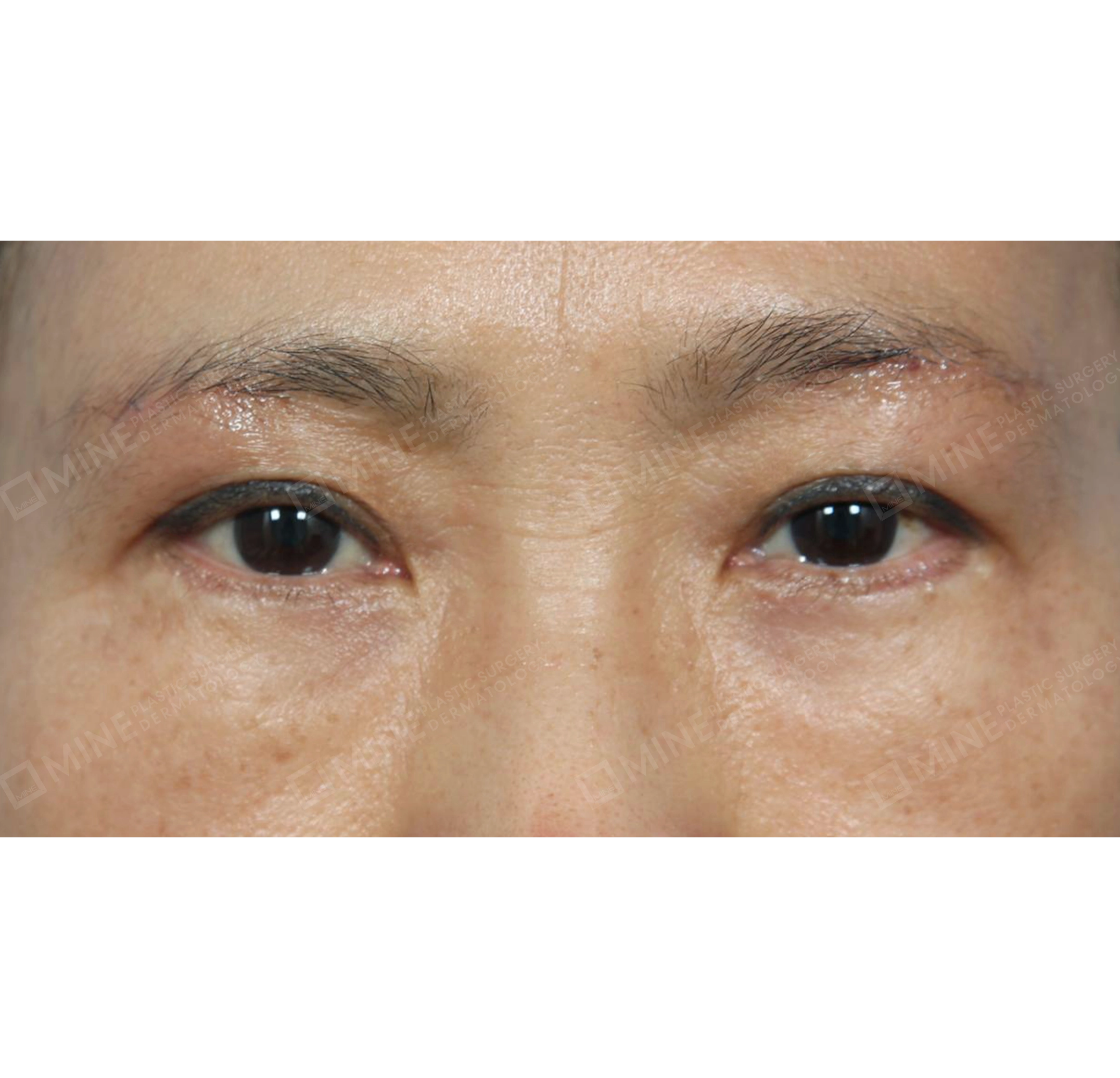 Lifting Bawah Alis + Koreksi Ptosis Insisi-Depan-Sesudah