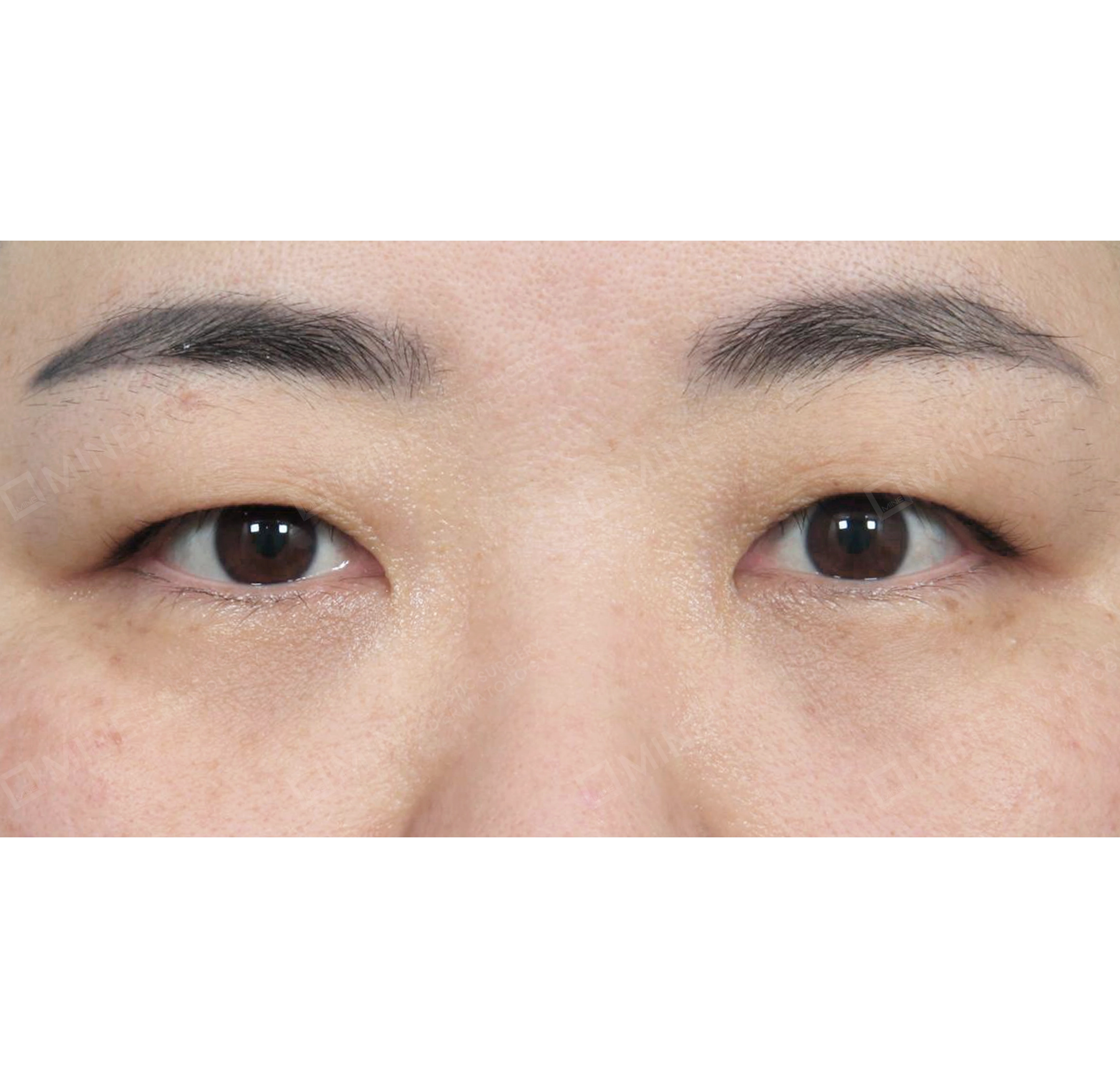 Koreksi Ptosis-Depan-Sebelum