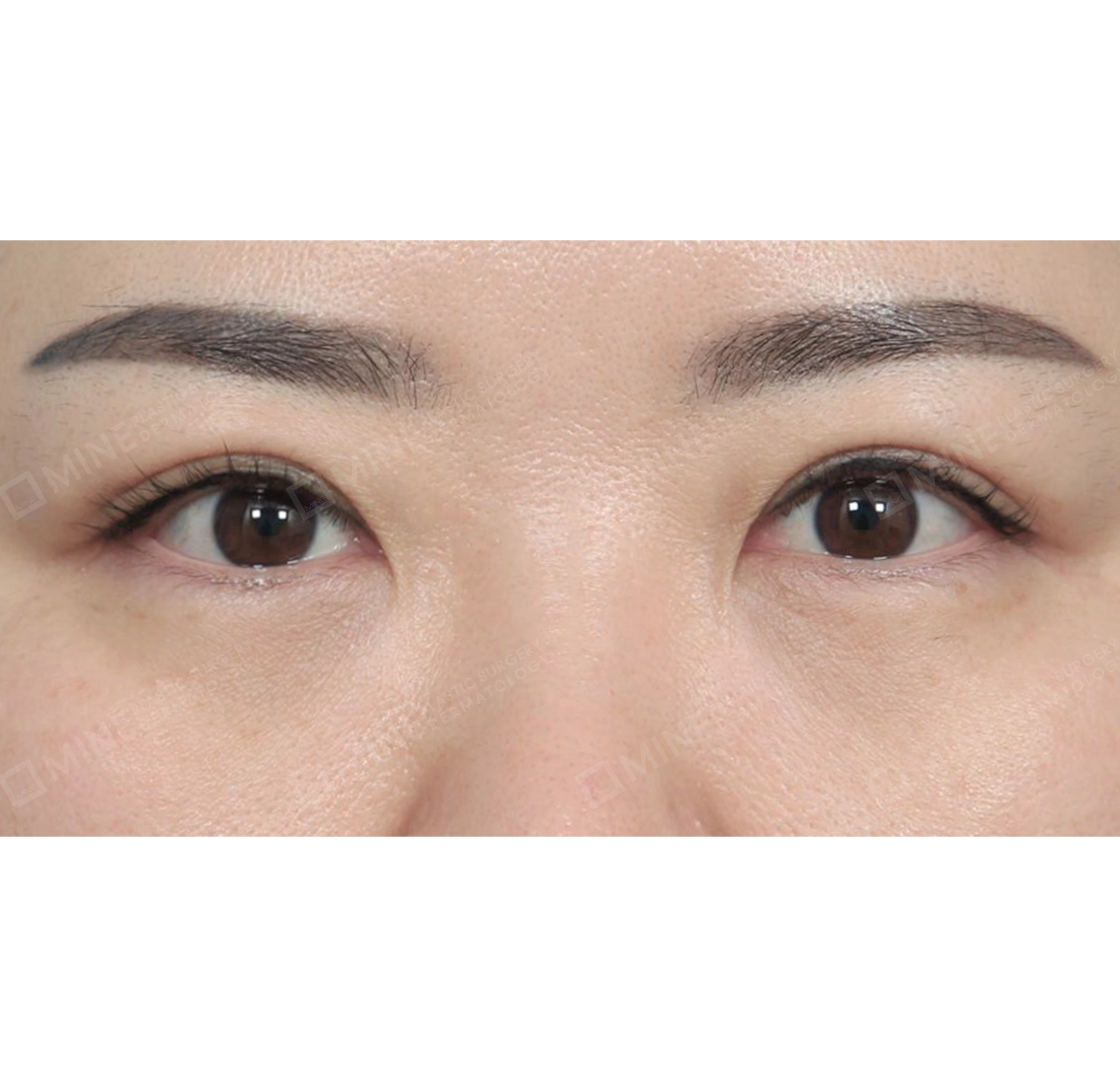 Koreksi Ptosis-Depan-Sesudah