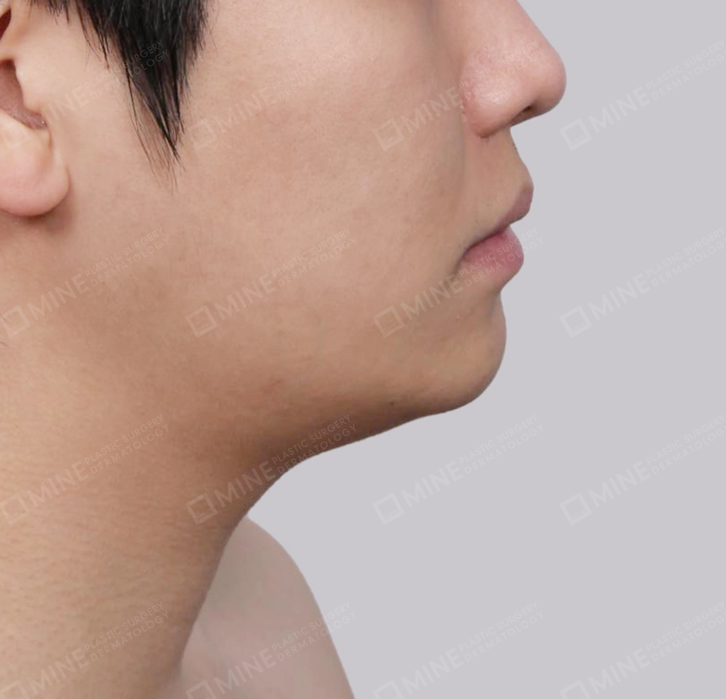 Lifting Leher Mini-Samping-Sebelum