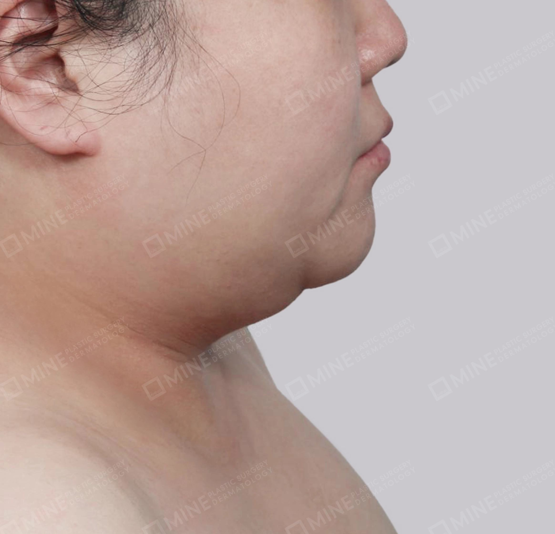 Lifting Leher Mini-Samping-Sebelum