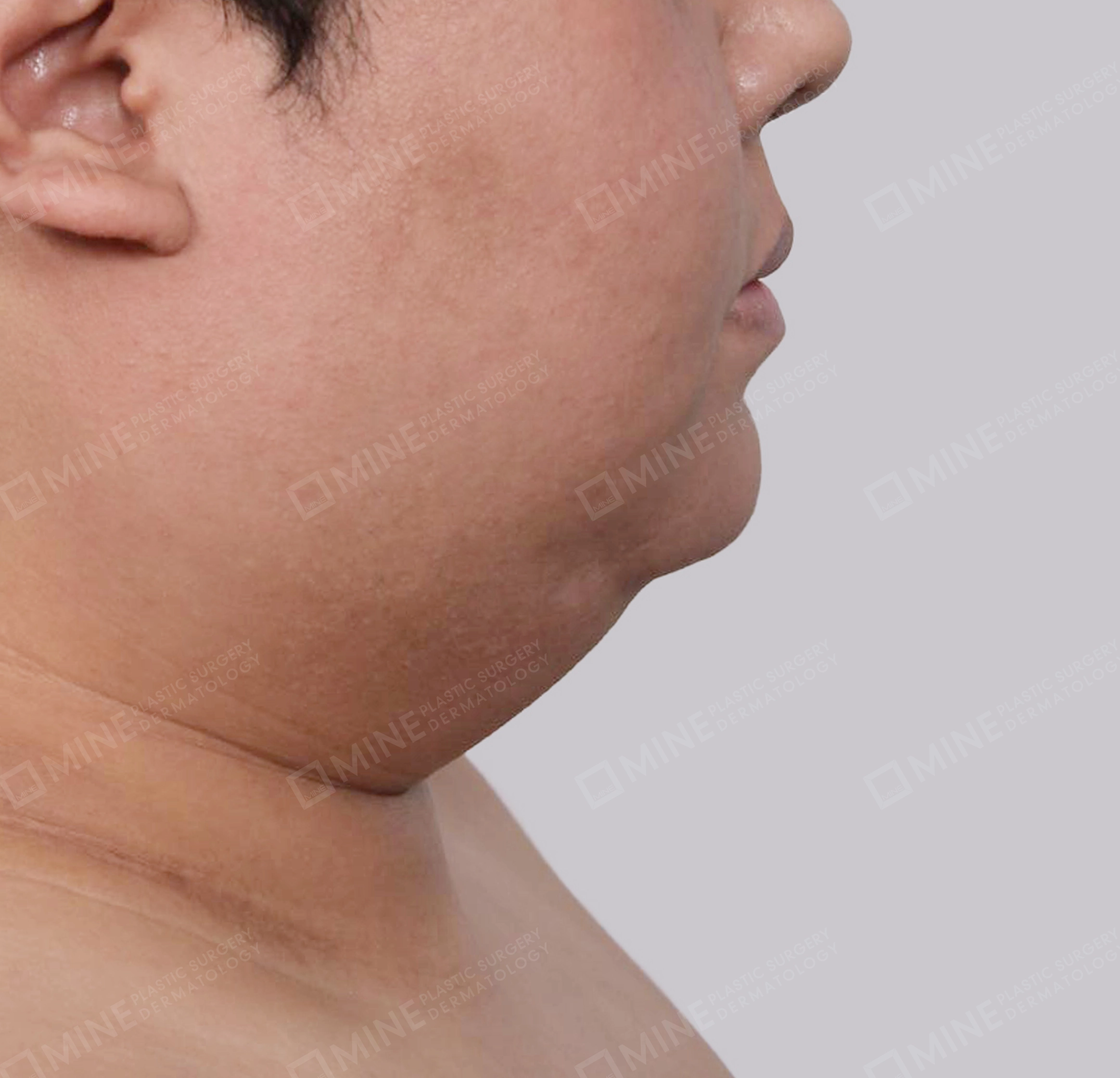 Lifting Leher Mini-Samping-Sebelum
