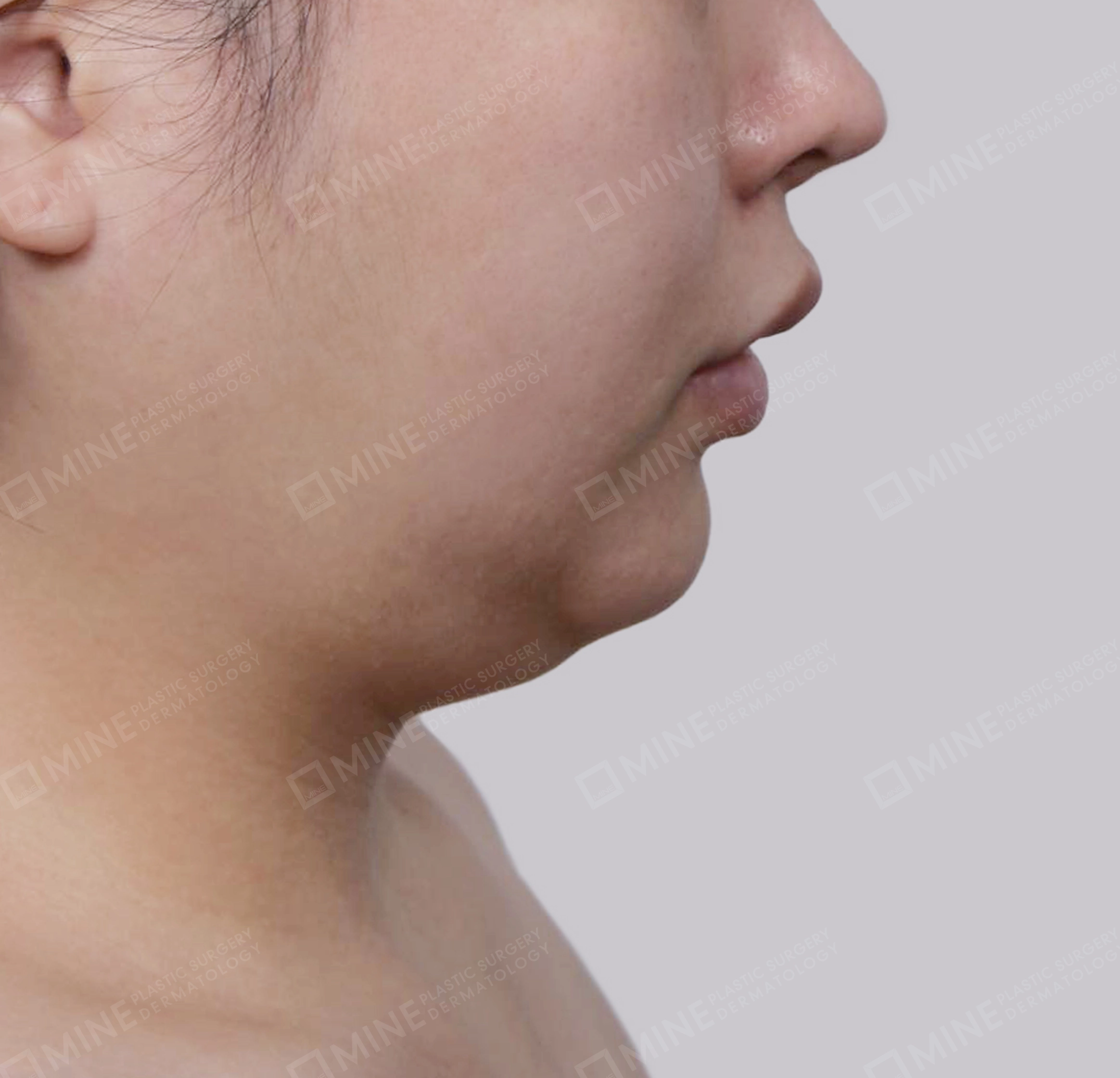 Lifting Leher Mini-Samping-Sebelum