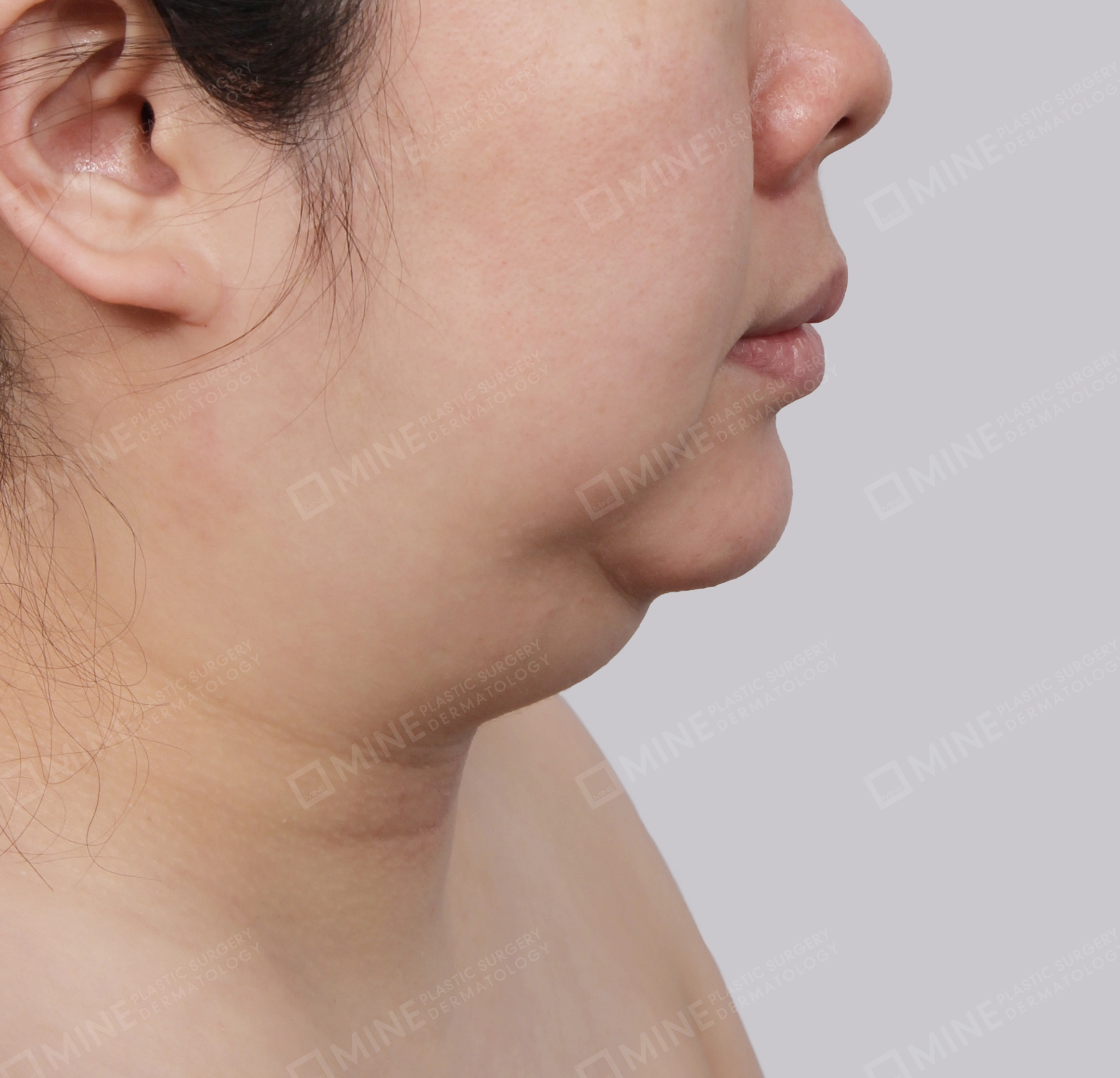 Lifting Leher Mini-Samping-Sebelum