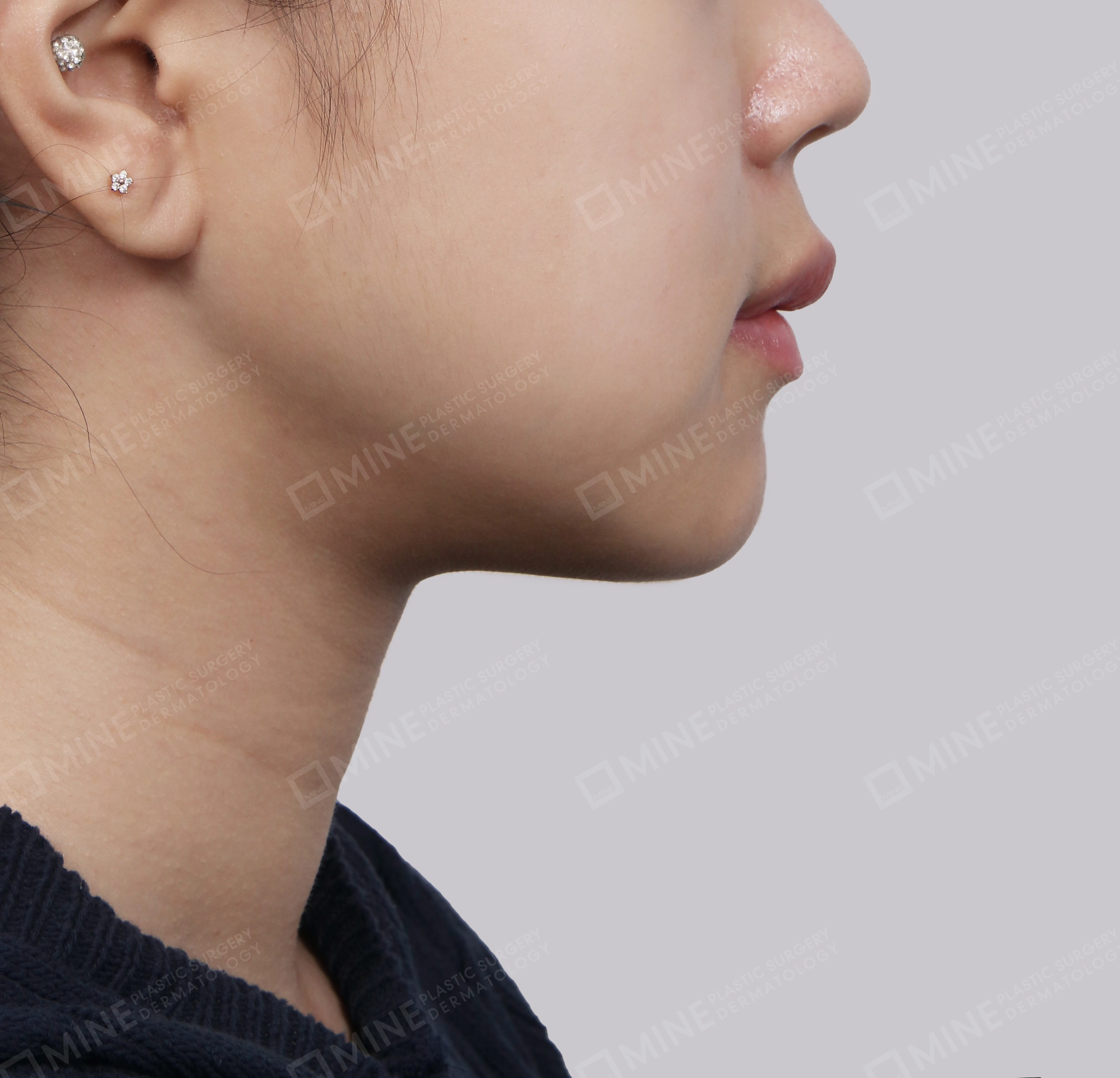Lifting Leher Mini-Samping-Sesudah