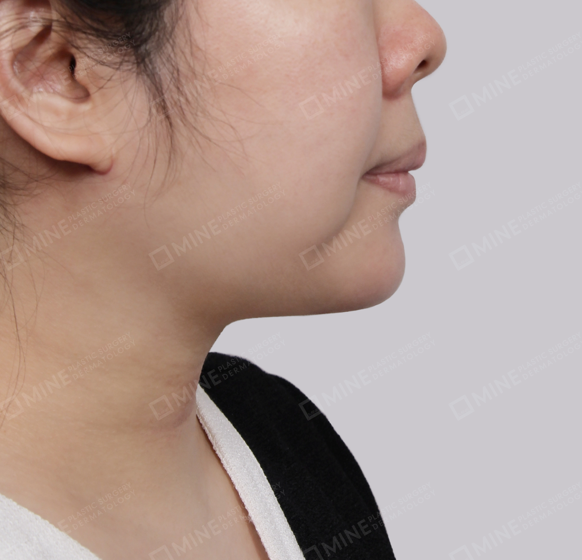 Lifting Leher Mini-Samping-Sesudah