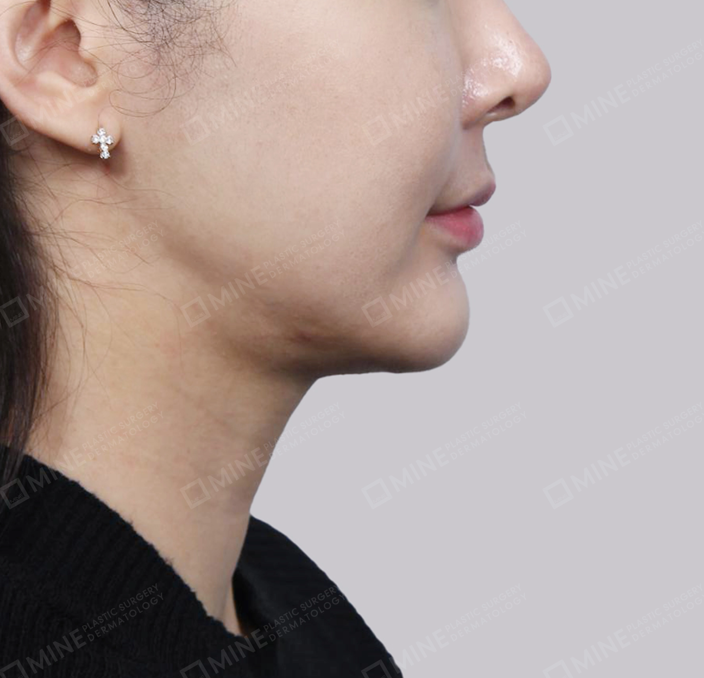 Vlimming (Dagu Ganda) + Eksisi kelenjar submandibula-Depan-Sebelum