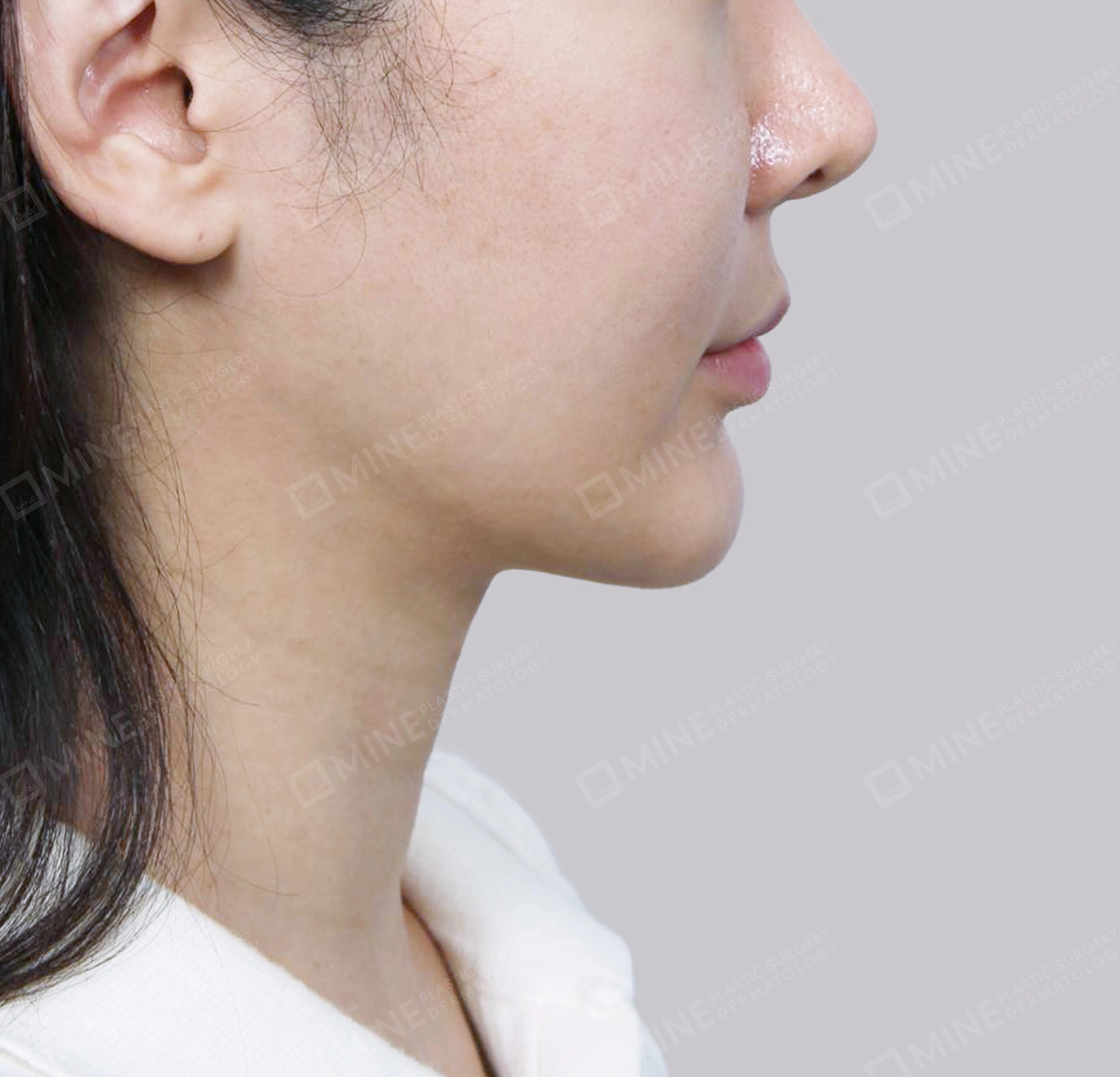 Vlimming (Dagu Ganda) + Eksisi kelenjar submandibula-Depan-Sesudah