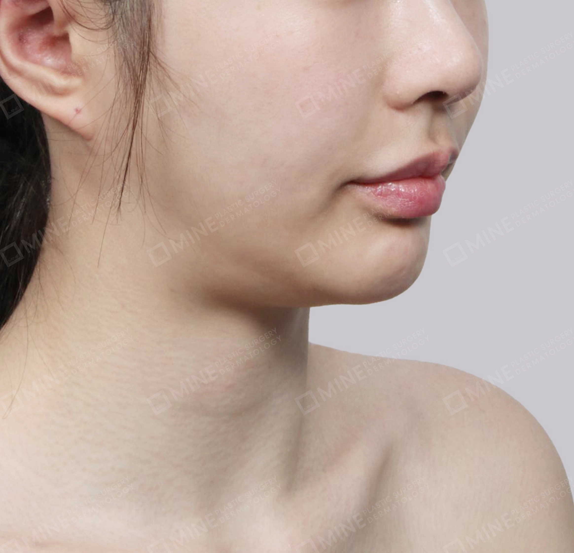 Vlimming (Dagu Ganda) + Eksisi kelenjar submandibula-Depan-Sebelum