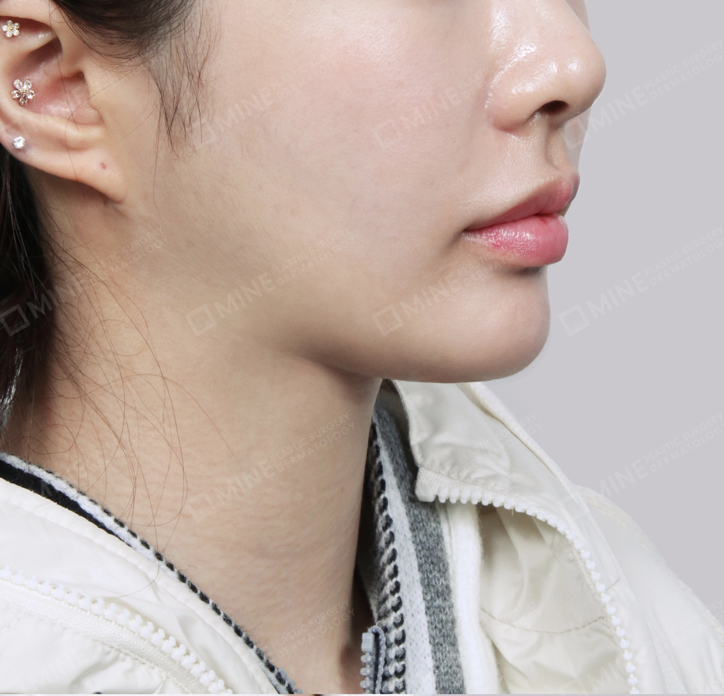 Vlimming (Dagu Ganda) + Eksisi kelenjar submandibula-Depan-Sesudah
