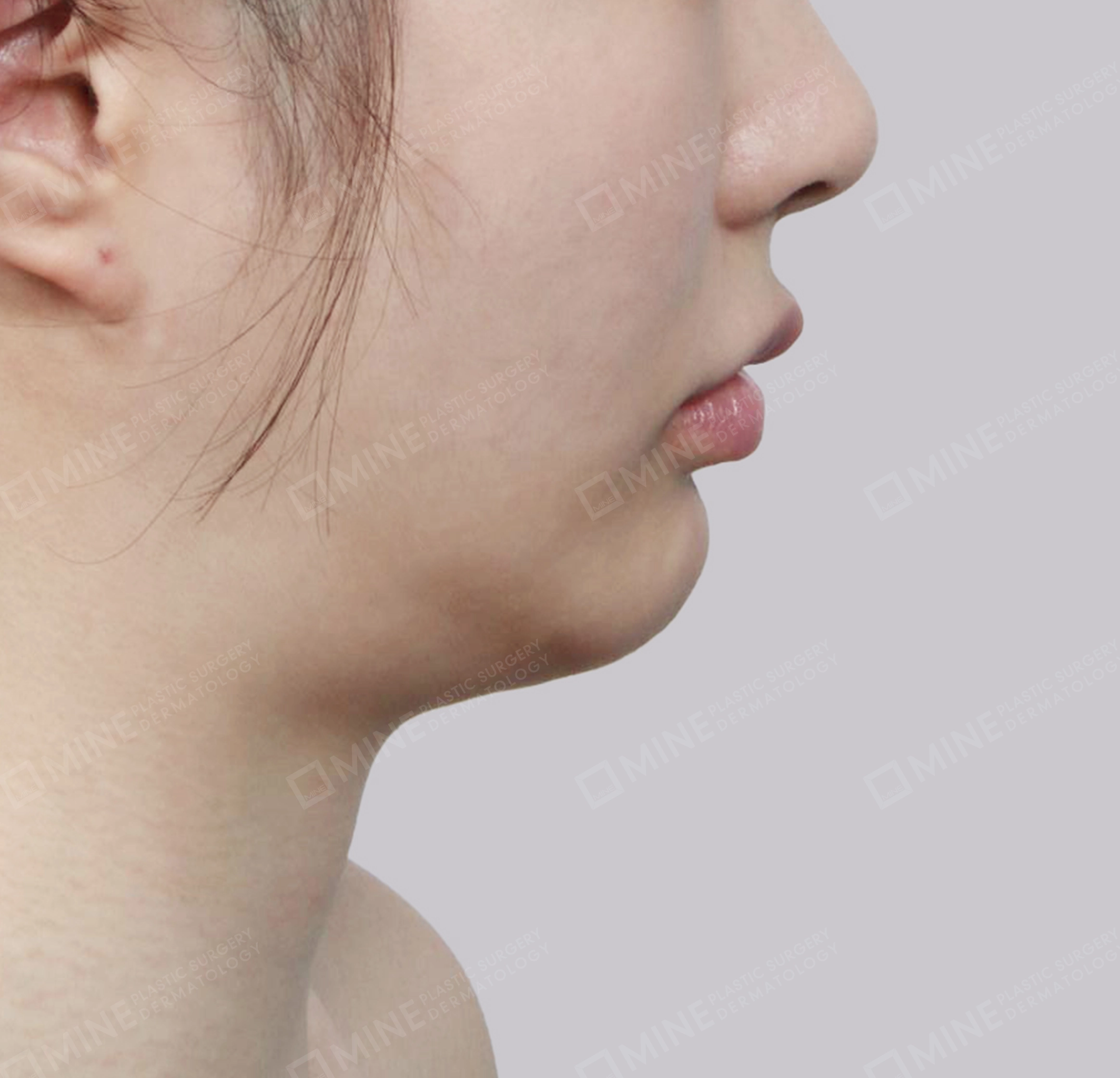 Vlimming (Dagu Ganda) + Eksisi kelenjar submandibula-Samping-Sebelum