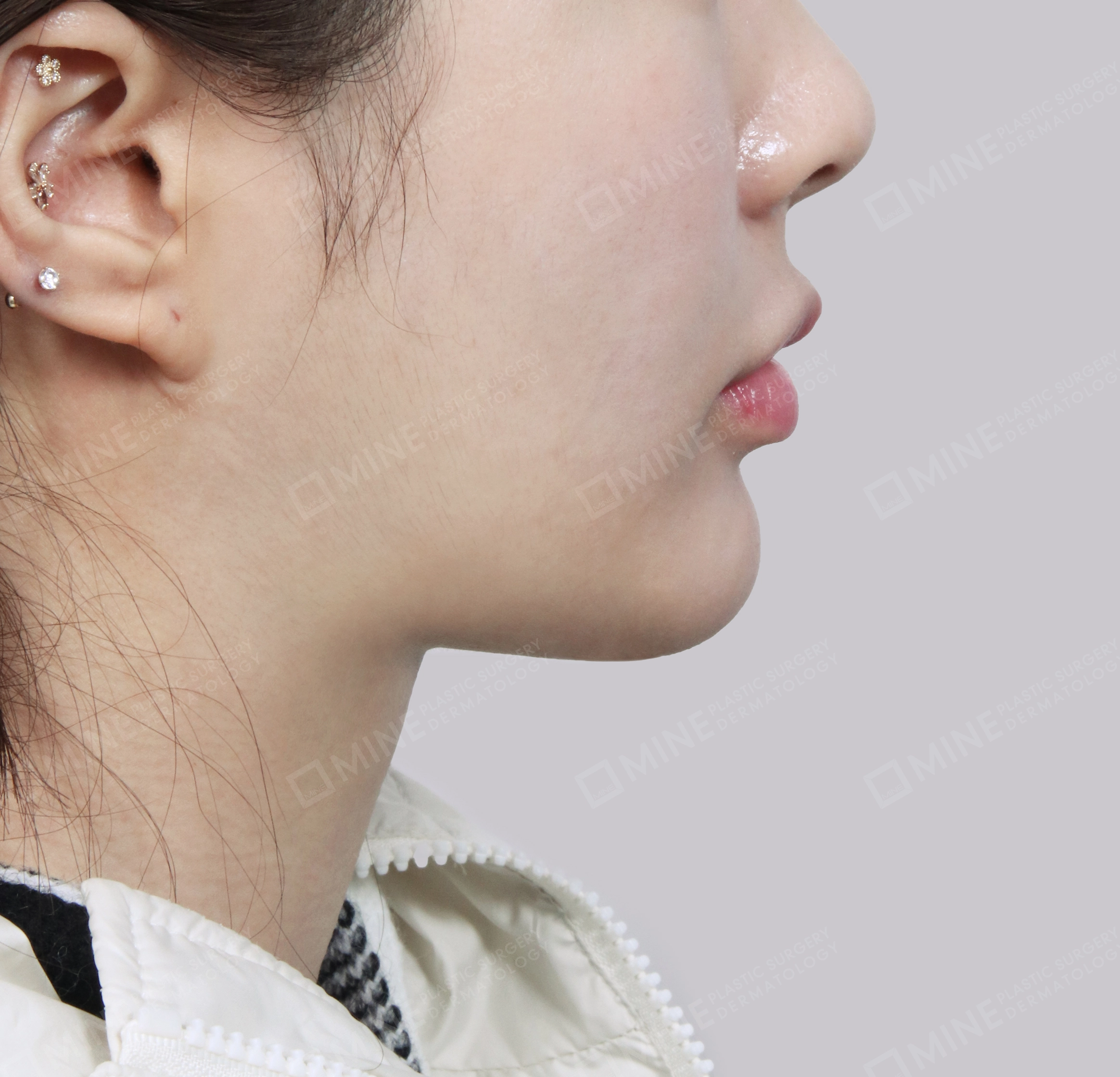 Vlimming (Dagu Ganda) + Eksisi kelenjar submandibula-Samping-Sesudah