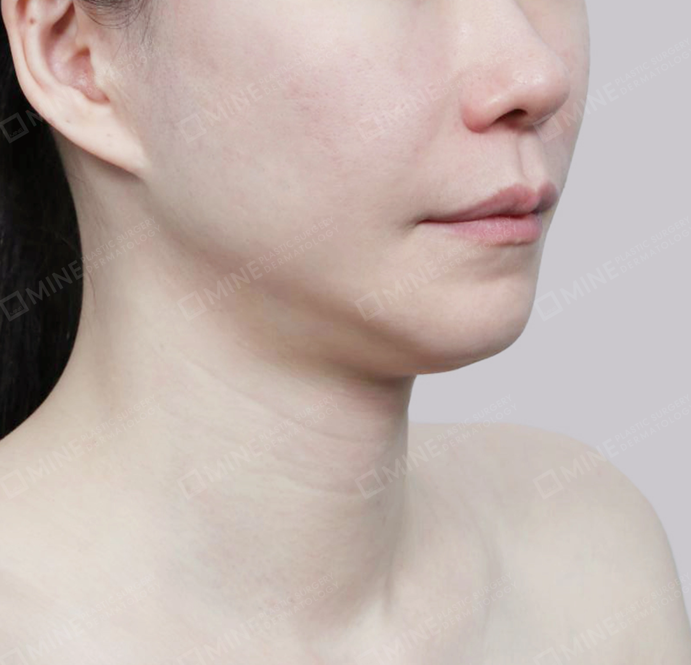 Vlimming (Dagu Ganda) + Eksisi kelenjar submandibula-Depan-Sebelum