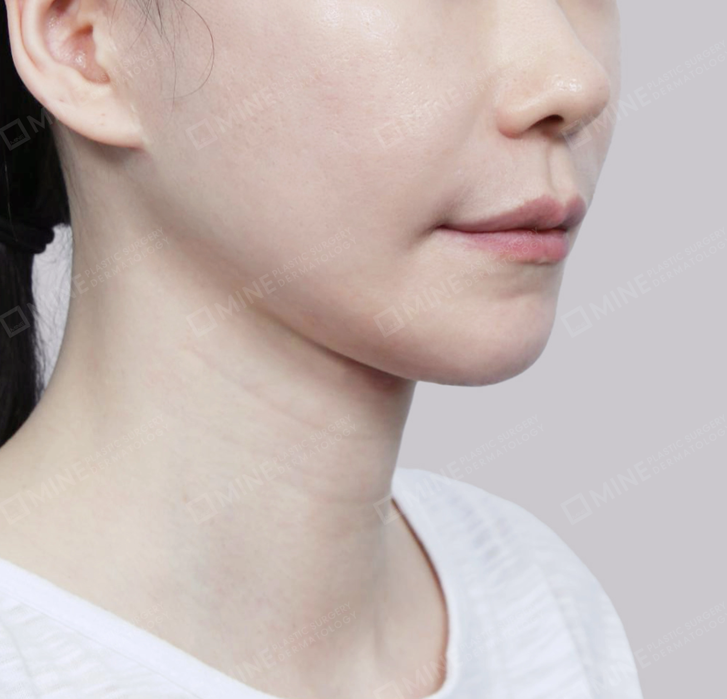 Vlimming (Dagu Ganda) + Eksisi kelenjar submandibula-Depan-Sesudah