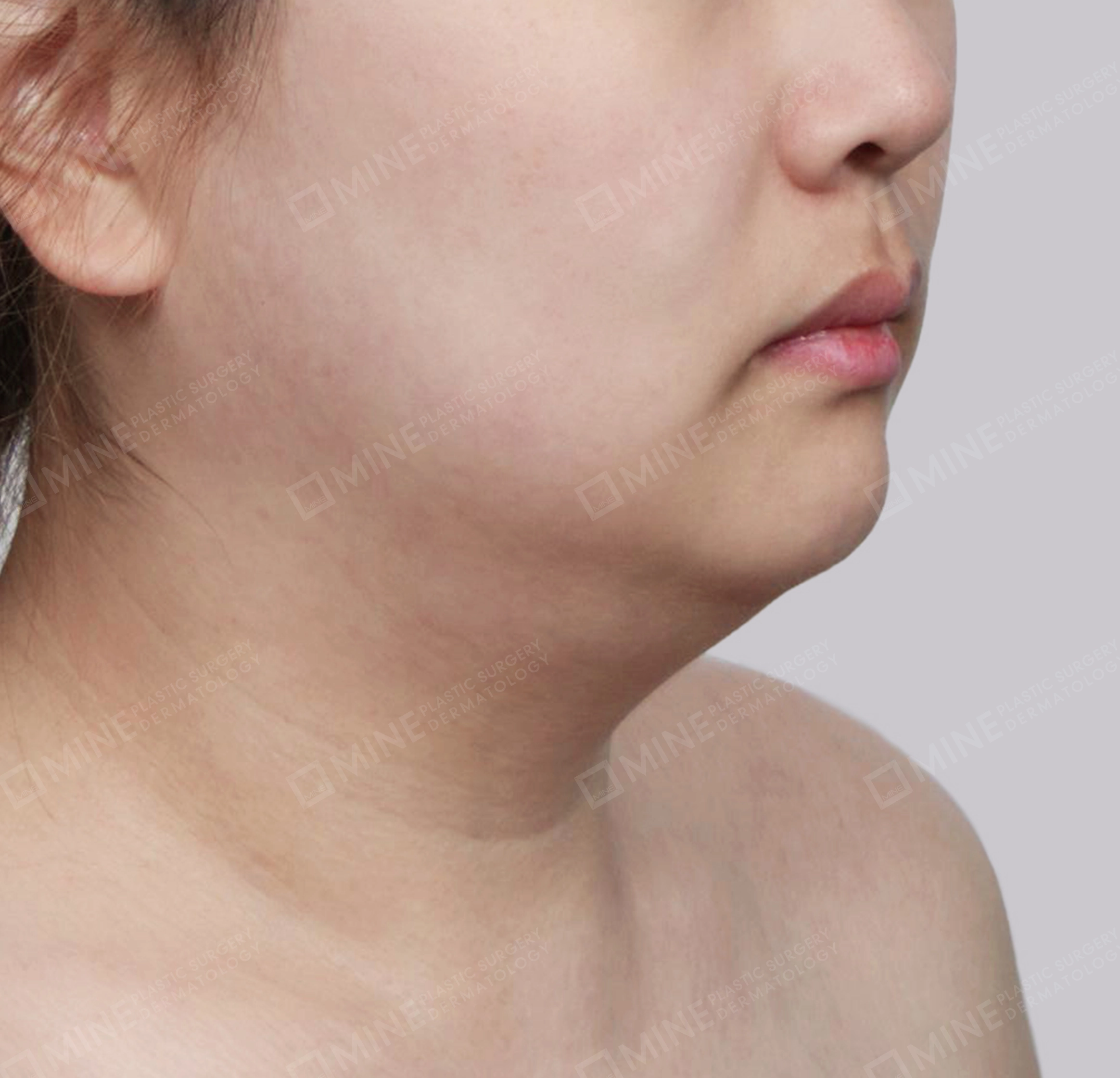 Vlimming (Dagu Ganda) + Eksisi kelenjar submandibula-Depan-Sebelum