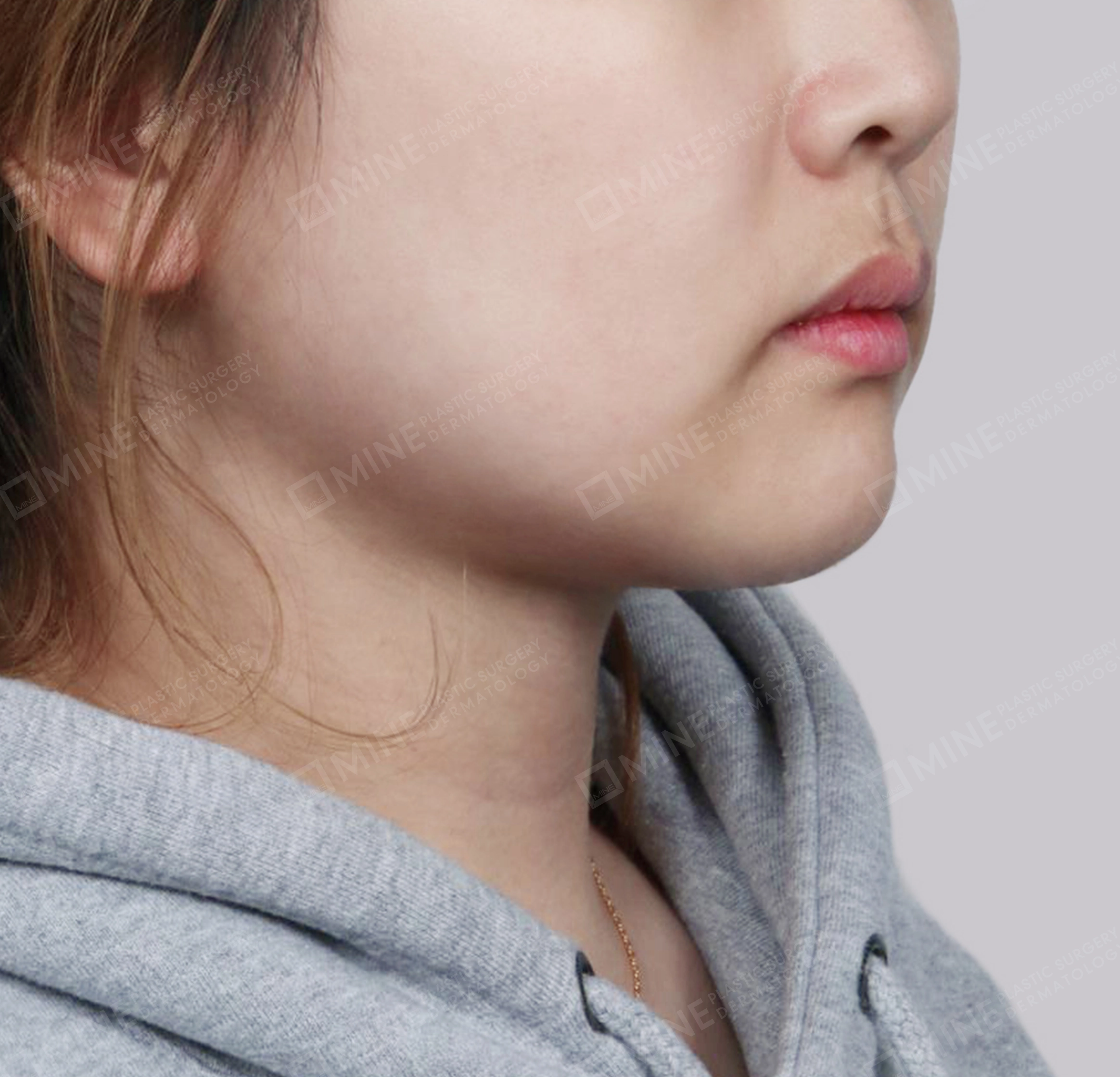 Vlimming (Dagu Ganda) + Eksisi kelenjar submandibula-Depan-Sesudah