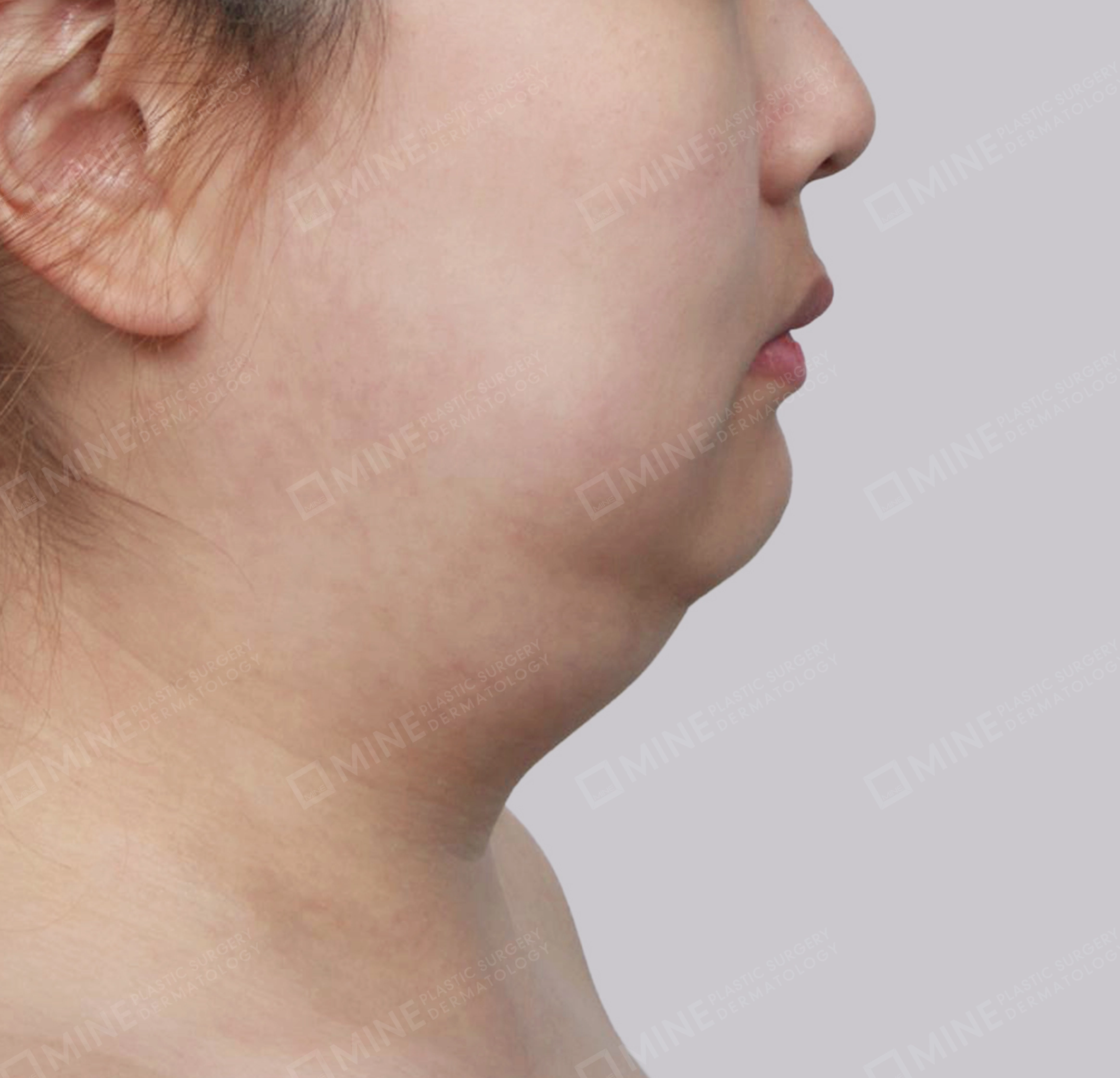 Vlimming (Dagu Ganda) + Eksisi kelenjar submandibula-Samping-Sebelum