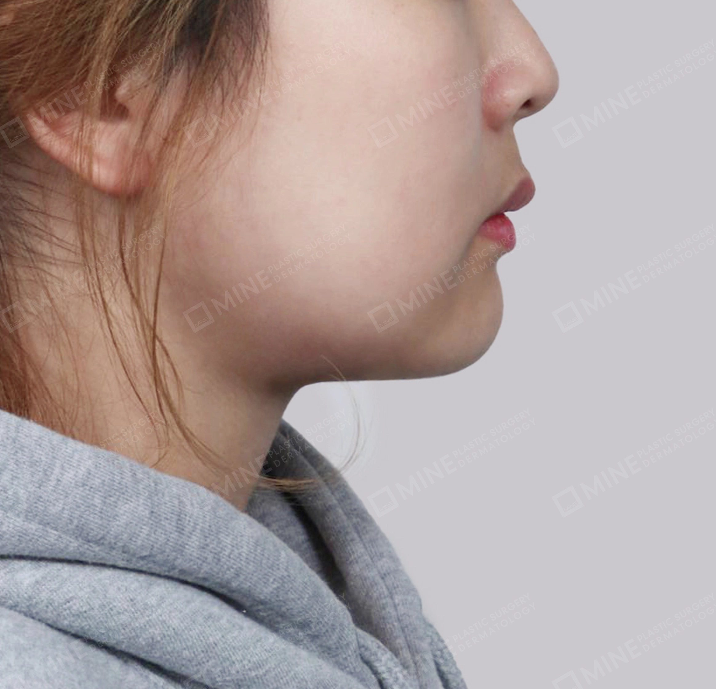 Vlimming (Dagu Ganda) + Eksisi kelenjar submandibula-Samping-Sesudah
