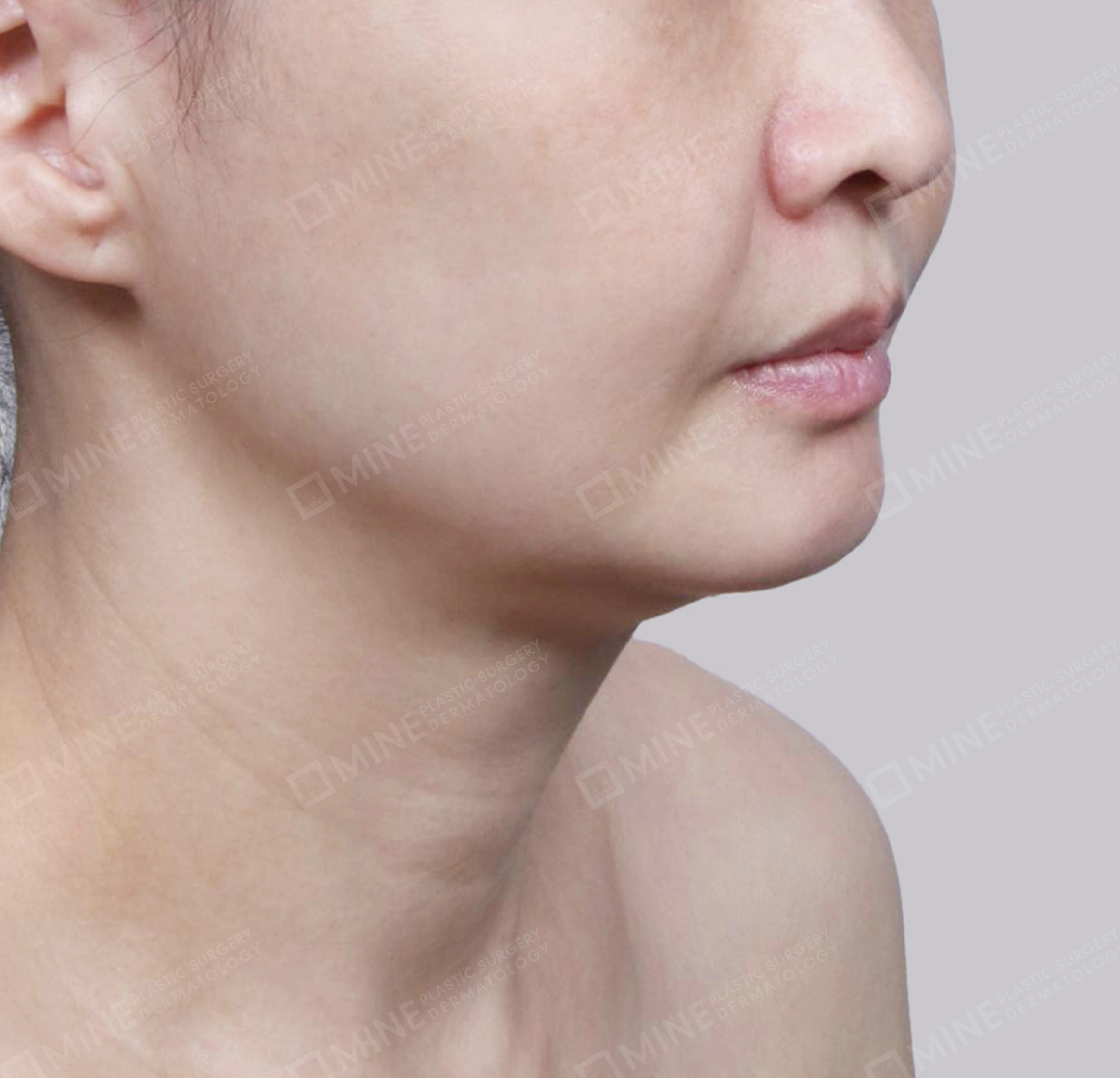 Vlimming (Dagu Ganda) + Eksisi kelenjar submandibula-Depan-Sebelum