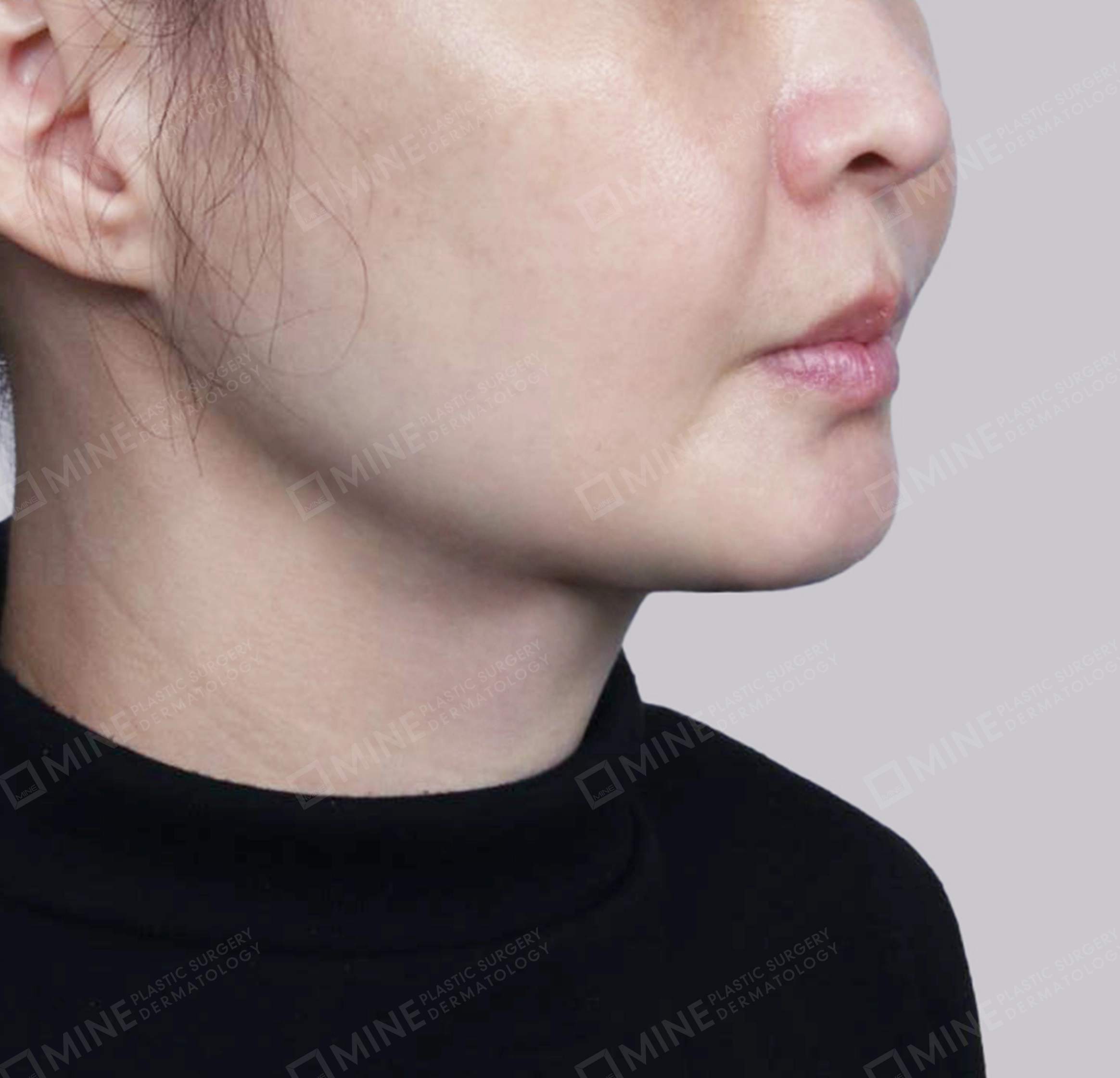 Vlimming (Dagu Ganda) + Eksisi kelenjar submandibula-Depan-Sesudah