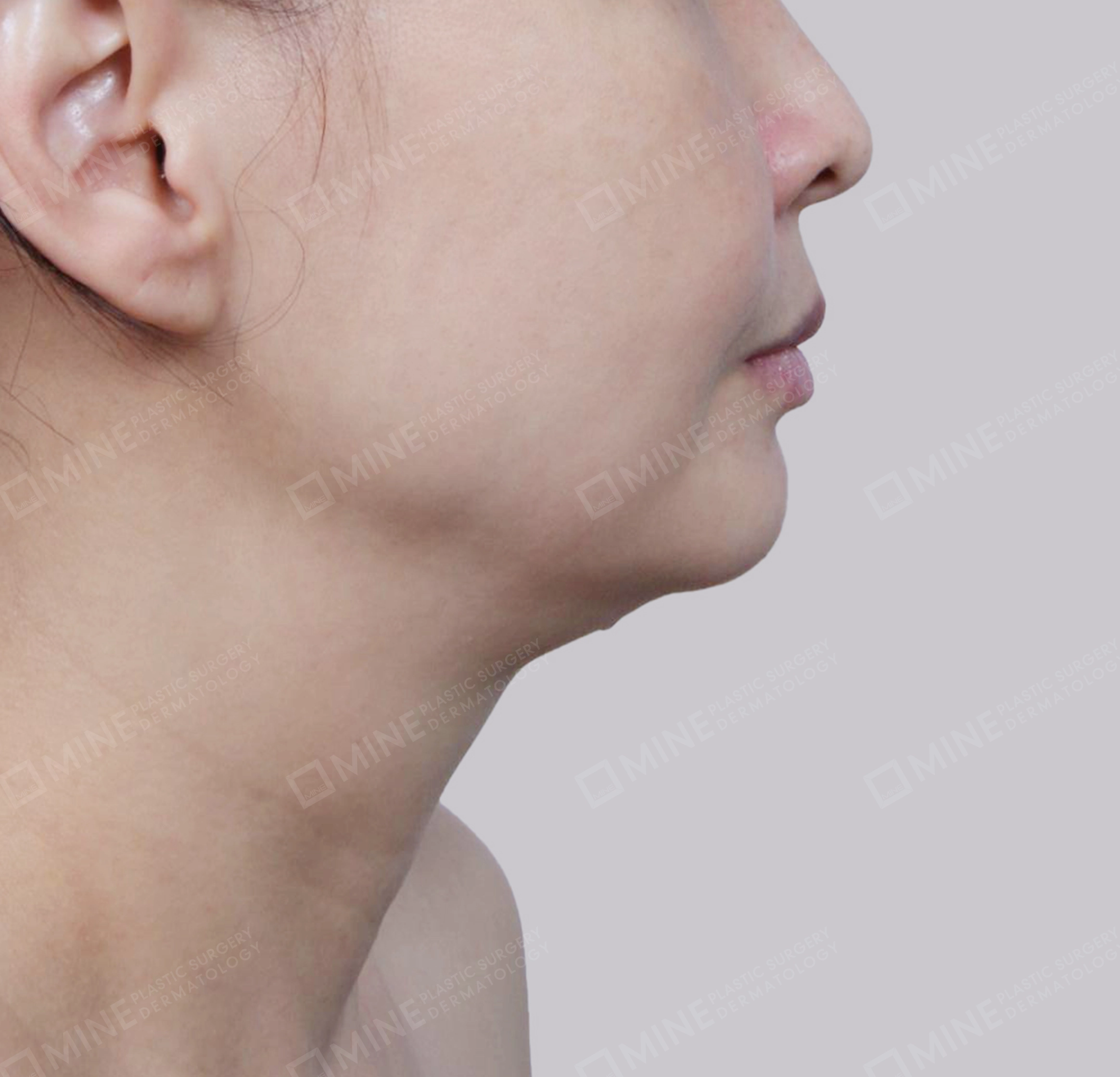 Vlimming (Dagu Ganda) + Eksisi kelenjar submandibula-Samping-Sebelum