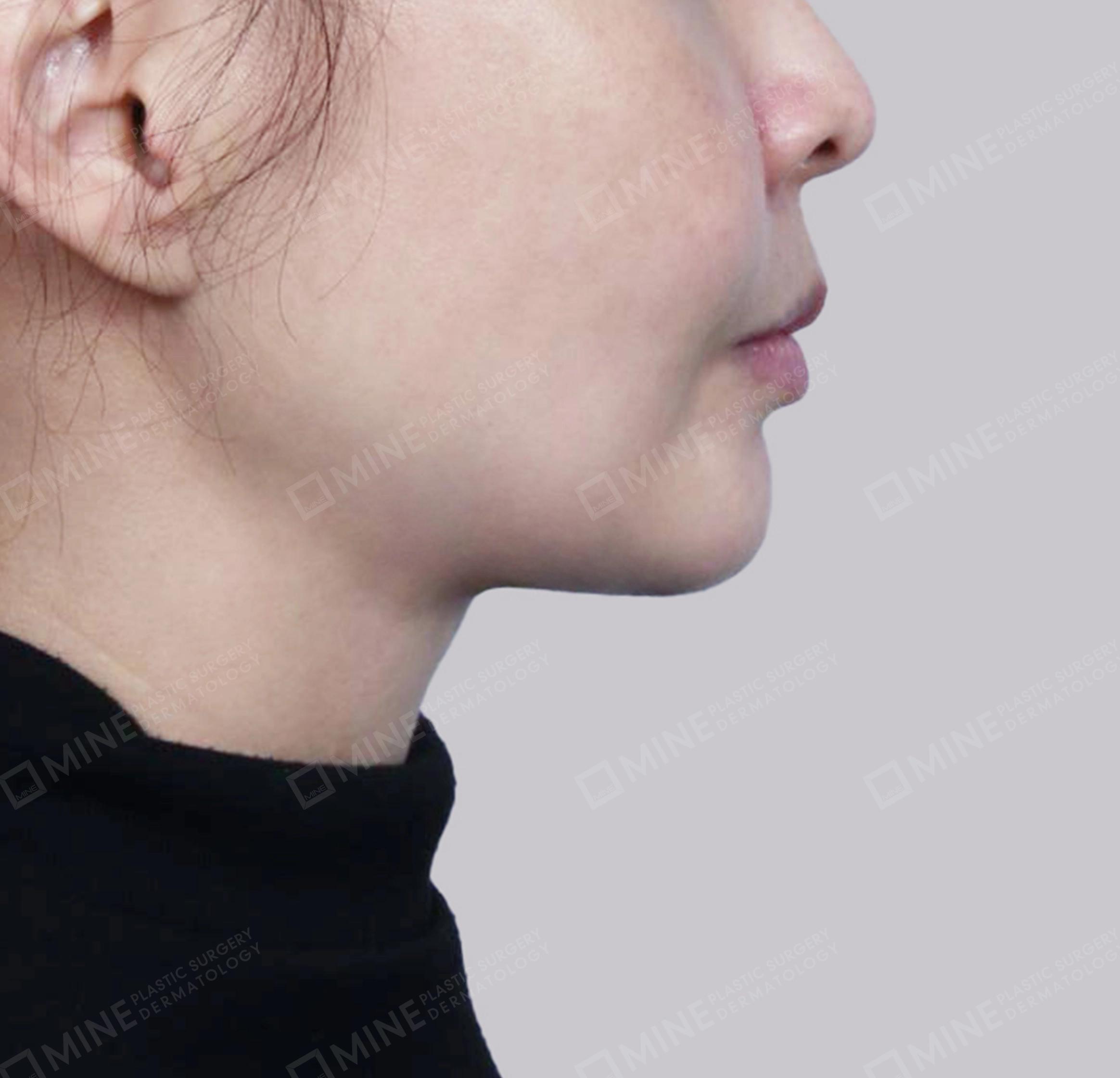 Vlimming (Dagu Ganda) + Eksisi kelenjar submandibula-Samping-Sesudah