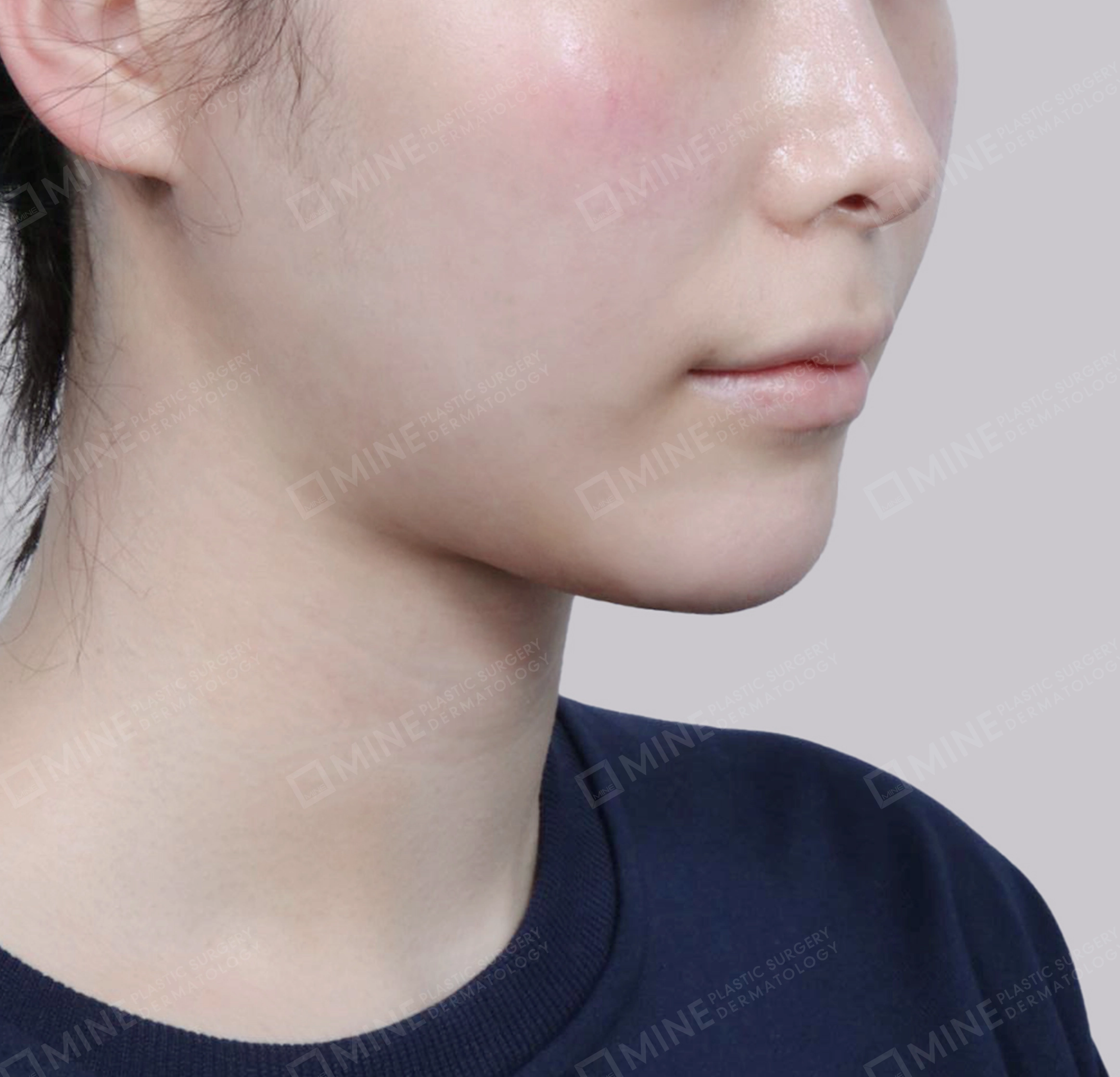 Vlimming (Dagu Ganda) + Eksisi kelenjar submandibula-Depan-Sesudah
