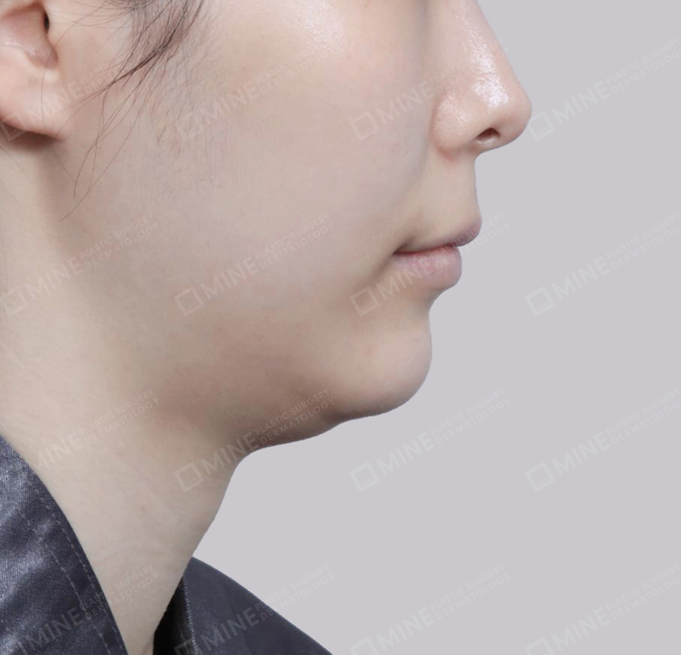 Vlimming (Dagu Ganda) + Eksisi kelenjar submandibula-Samping-Sebelum