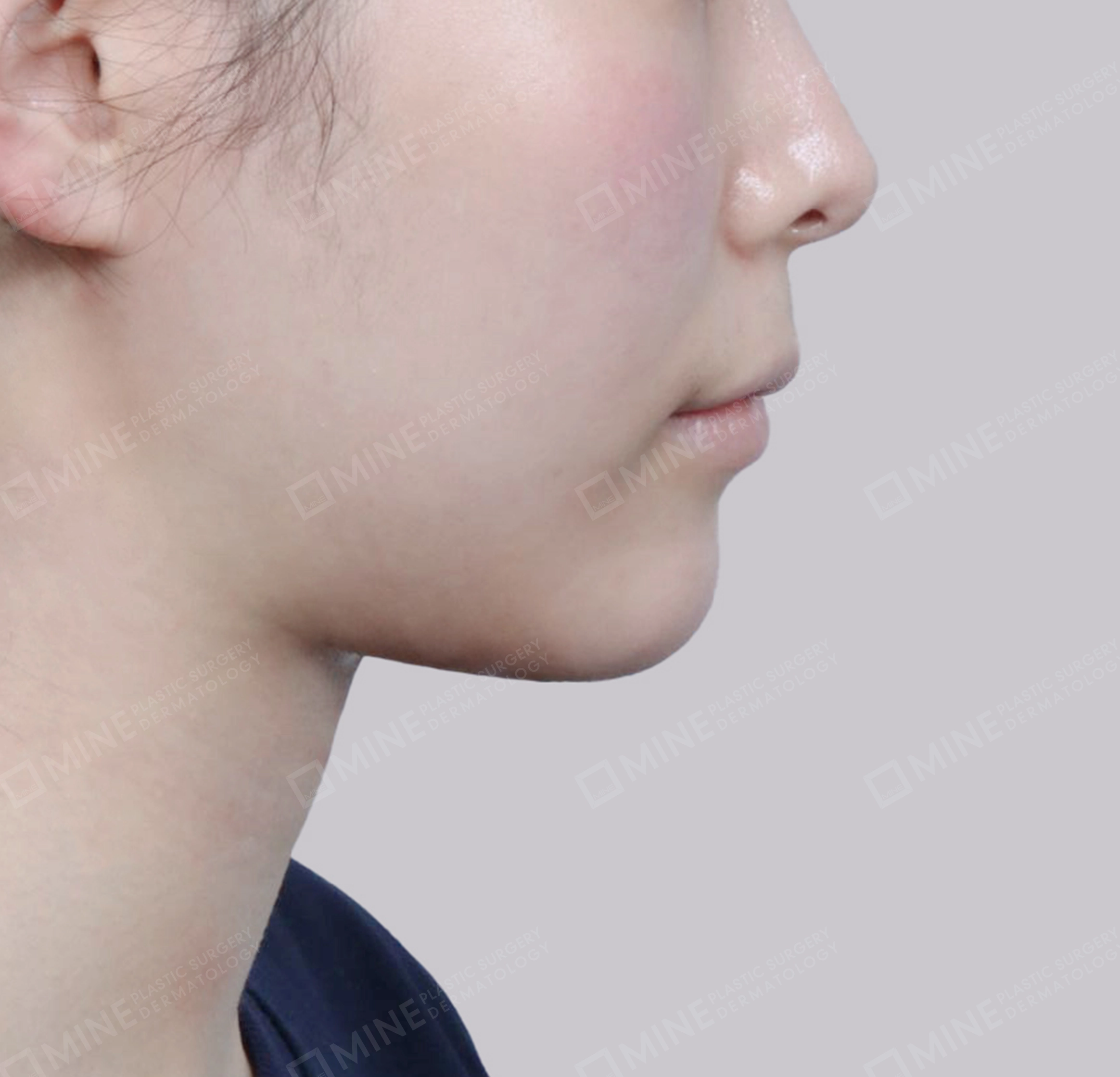 Vlimming (Dagu Ganda) + Eksisi kelenjar submandibula-Samping-Sesudah