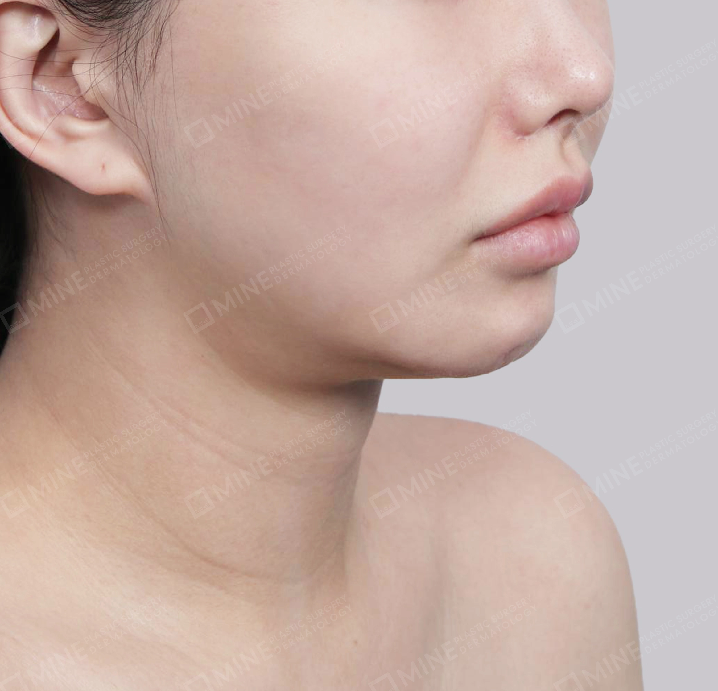 Vlimming (Dagu Ganda) + Eksisi kelenjar submandibula-Depan-Sebelum