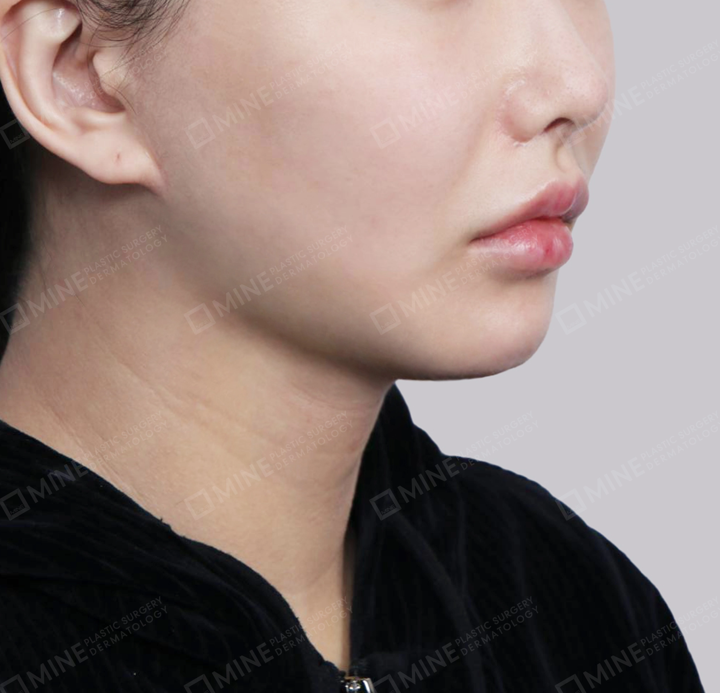 Vlimming (Dagu Ganda) + Eksisi kelenjar submandibula-Depan-Sesudah