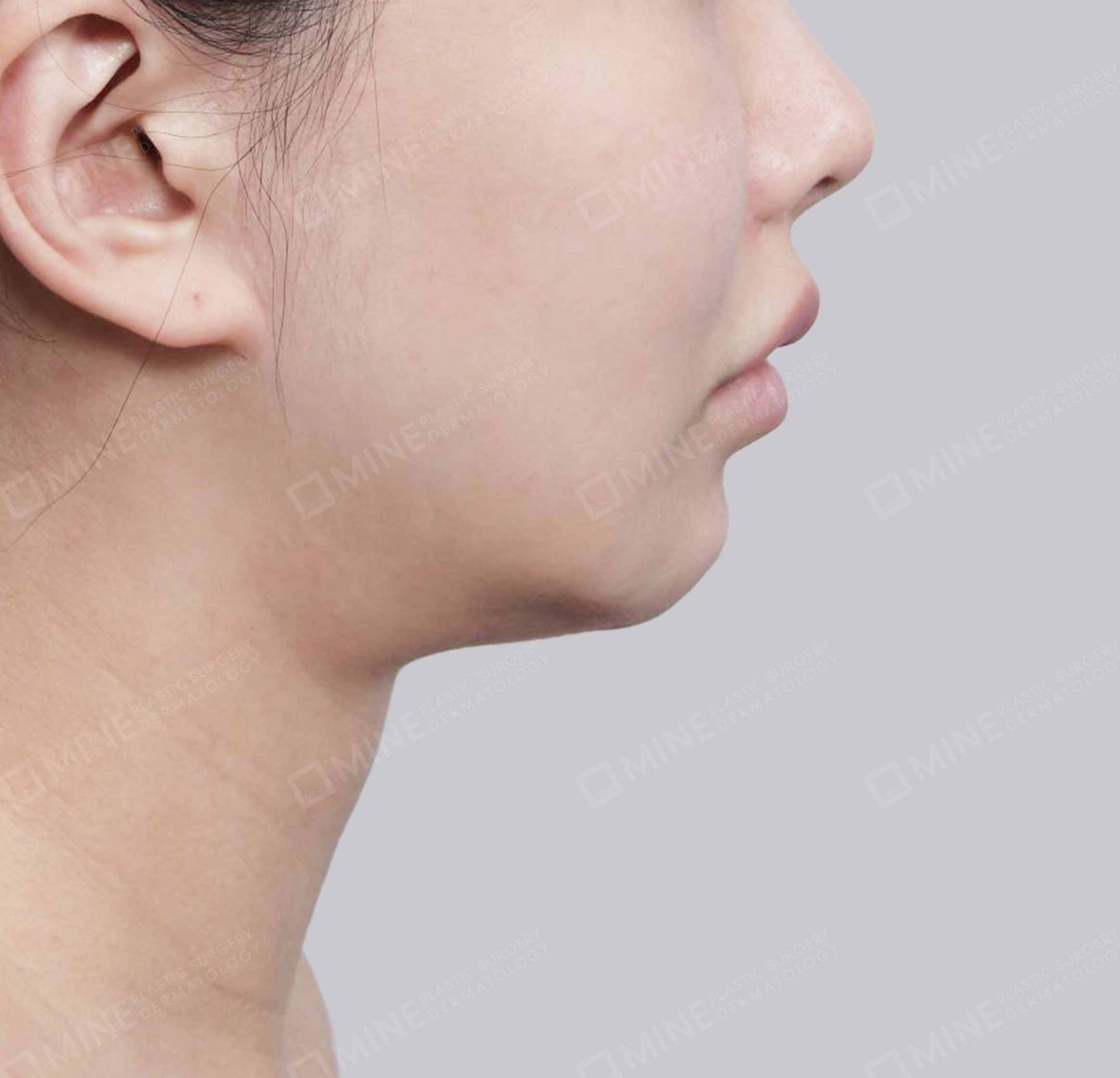 Vlimming (Dagu Ganda) + Eksisi kelenjar submandibula-Samping-Sebelum