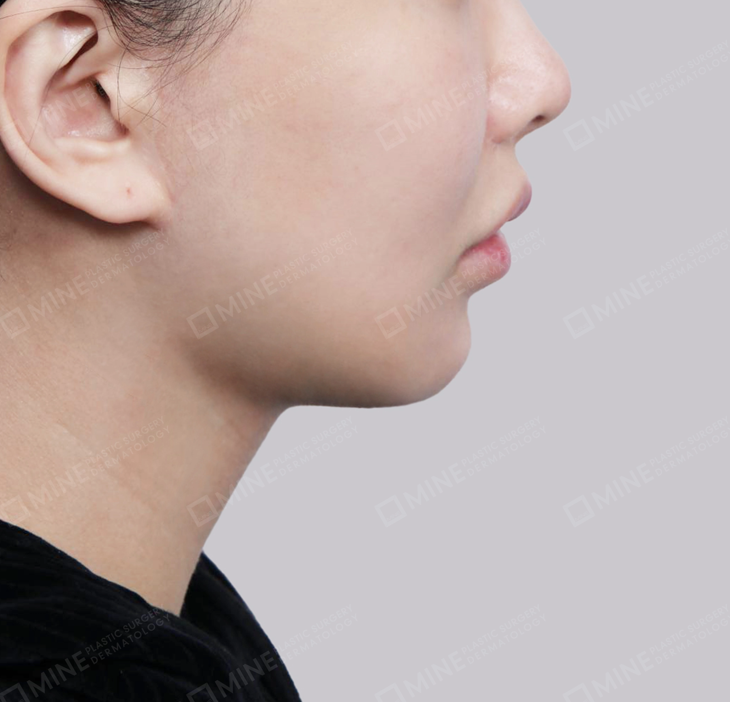 Vlimming (Dagu Ganda) + Eksisi kelenjar submandibula-Samping-Sesudah