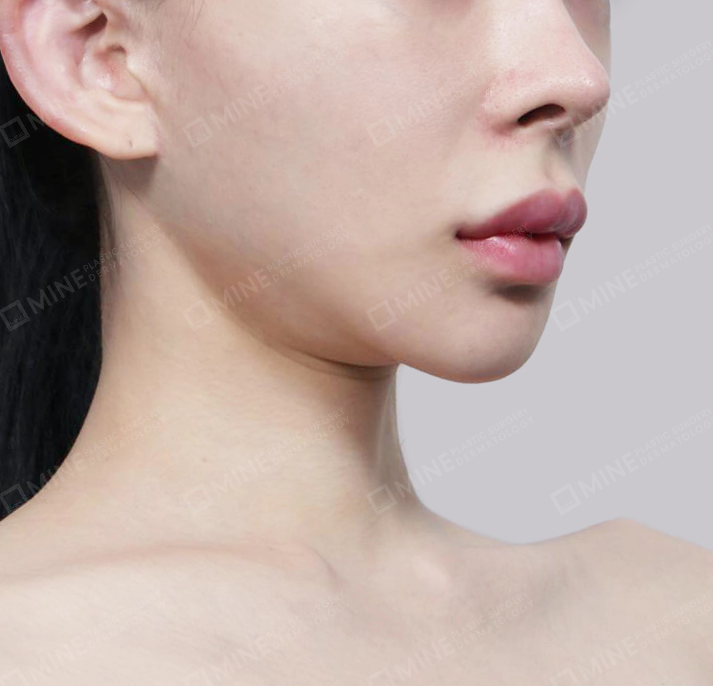 Vlimming (Dagu Ganda) + Eksisi kelenjar submandibula-Depan-Sebelum
