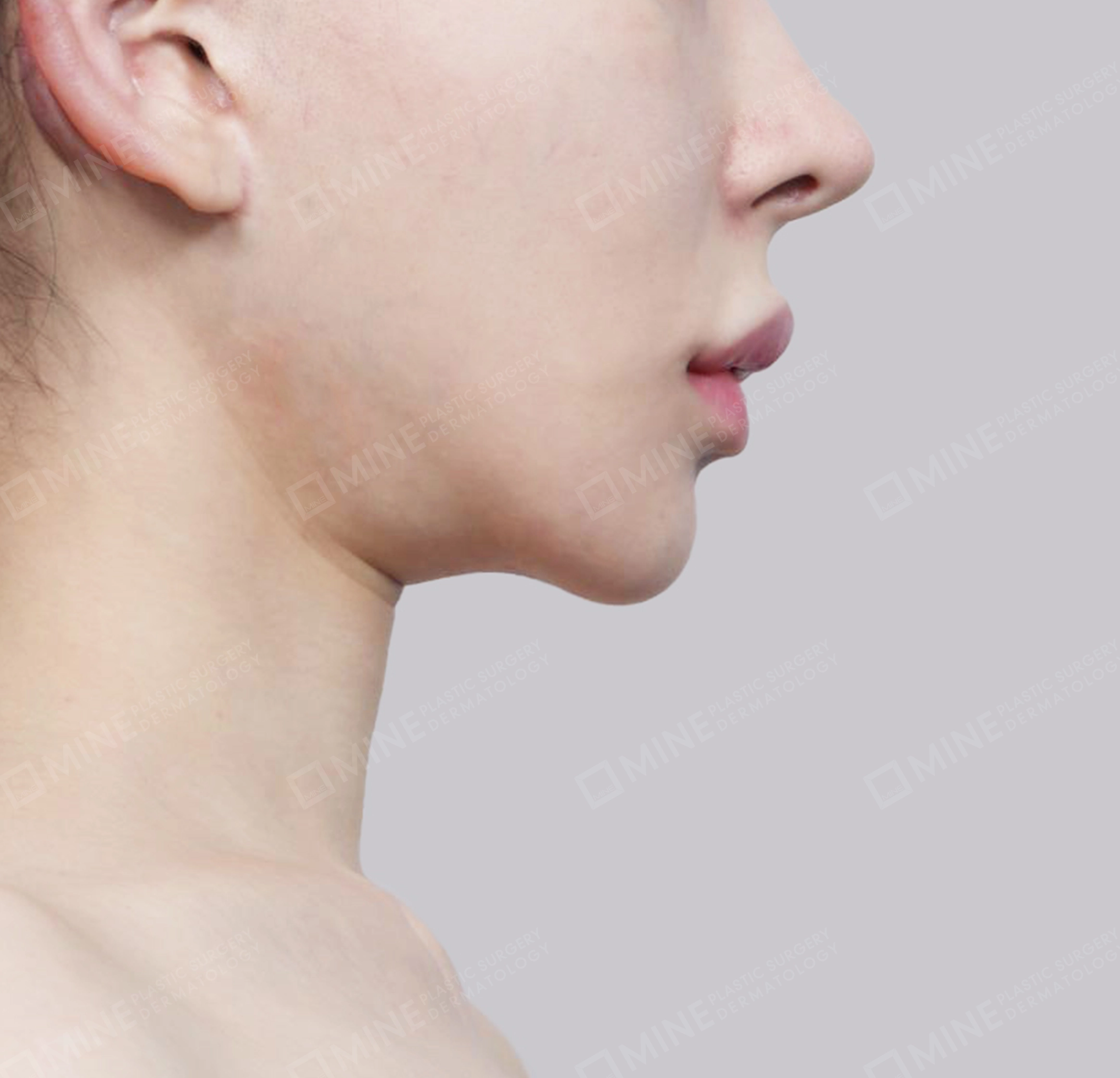 Vlimming (Dagu Ganda) + Eksisi kelenjar submandibula-Samping-Sebelum