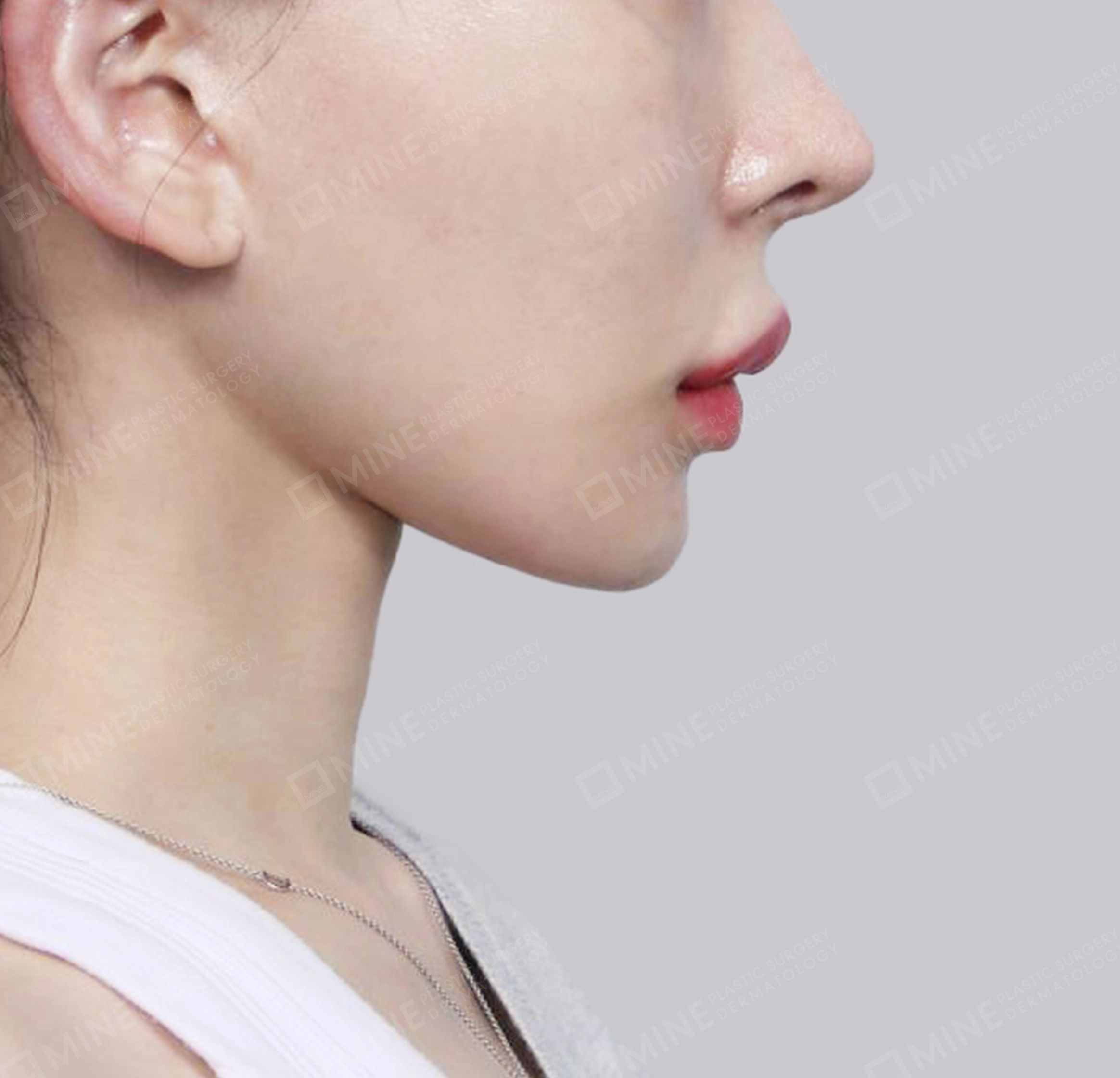 Vlimming (Dagu Ganda) + Eksisi kelenjar submandibula-Samping-Sesudah