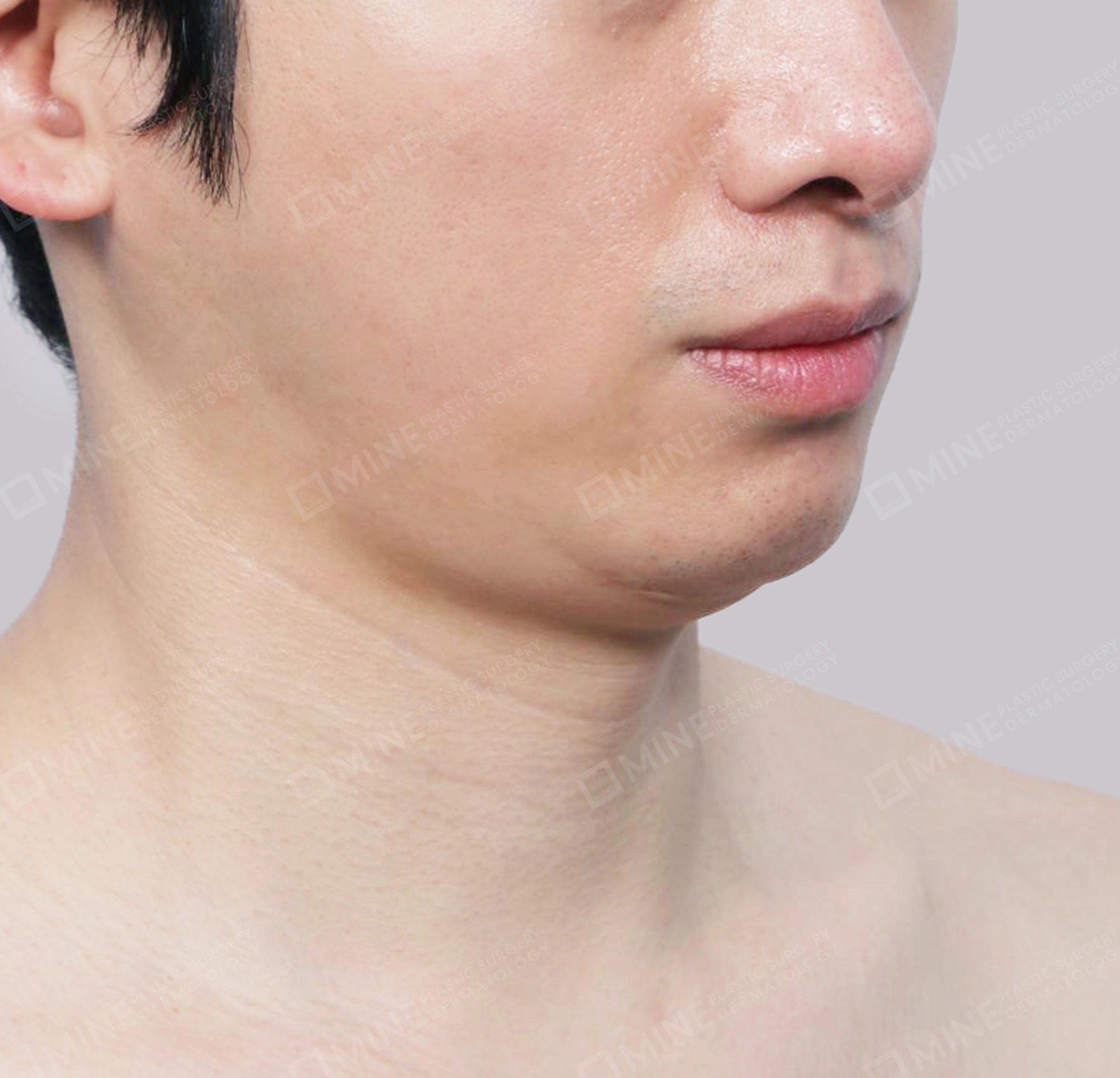 Vlimming (Dagu Ganda) + Eksisi kelenjar submandibula-Depan-Sebelum