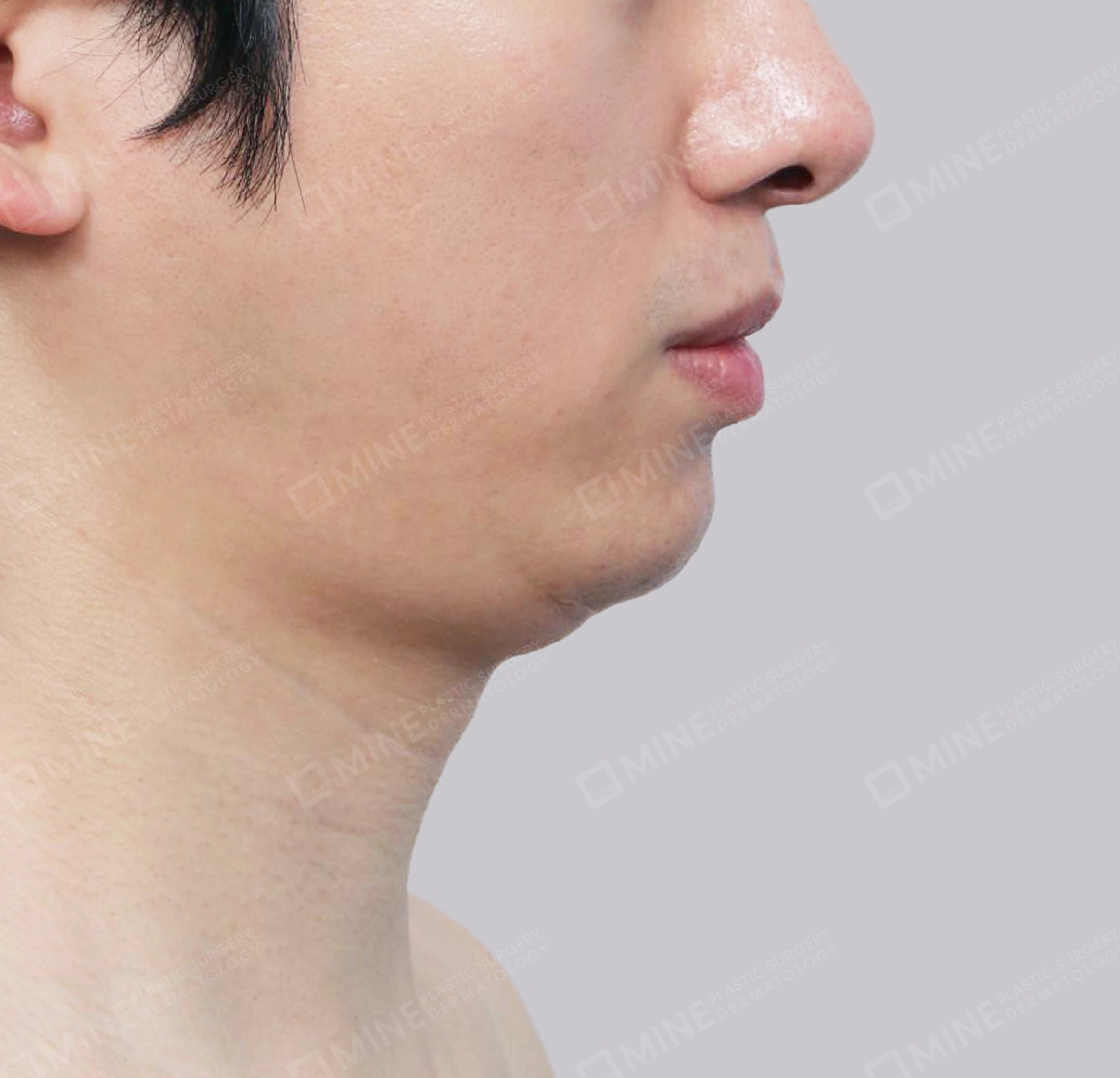 Vlimming (Dagu Ganda) + Eksisi kelenjar submandibula-Samping-Sebelum